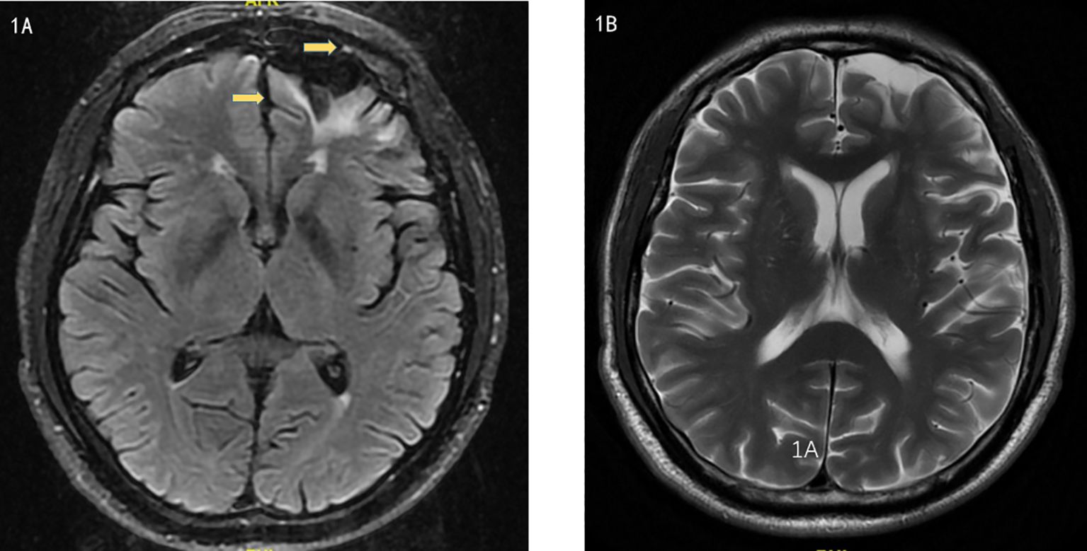 MRI brain scans in axial view. Image 1A shows a marked area with yellow arrows indicating a specific region. Image 1B shows a normal brain structure for comparison with no highlighted areas.