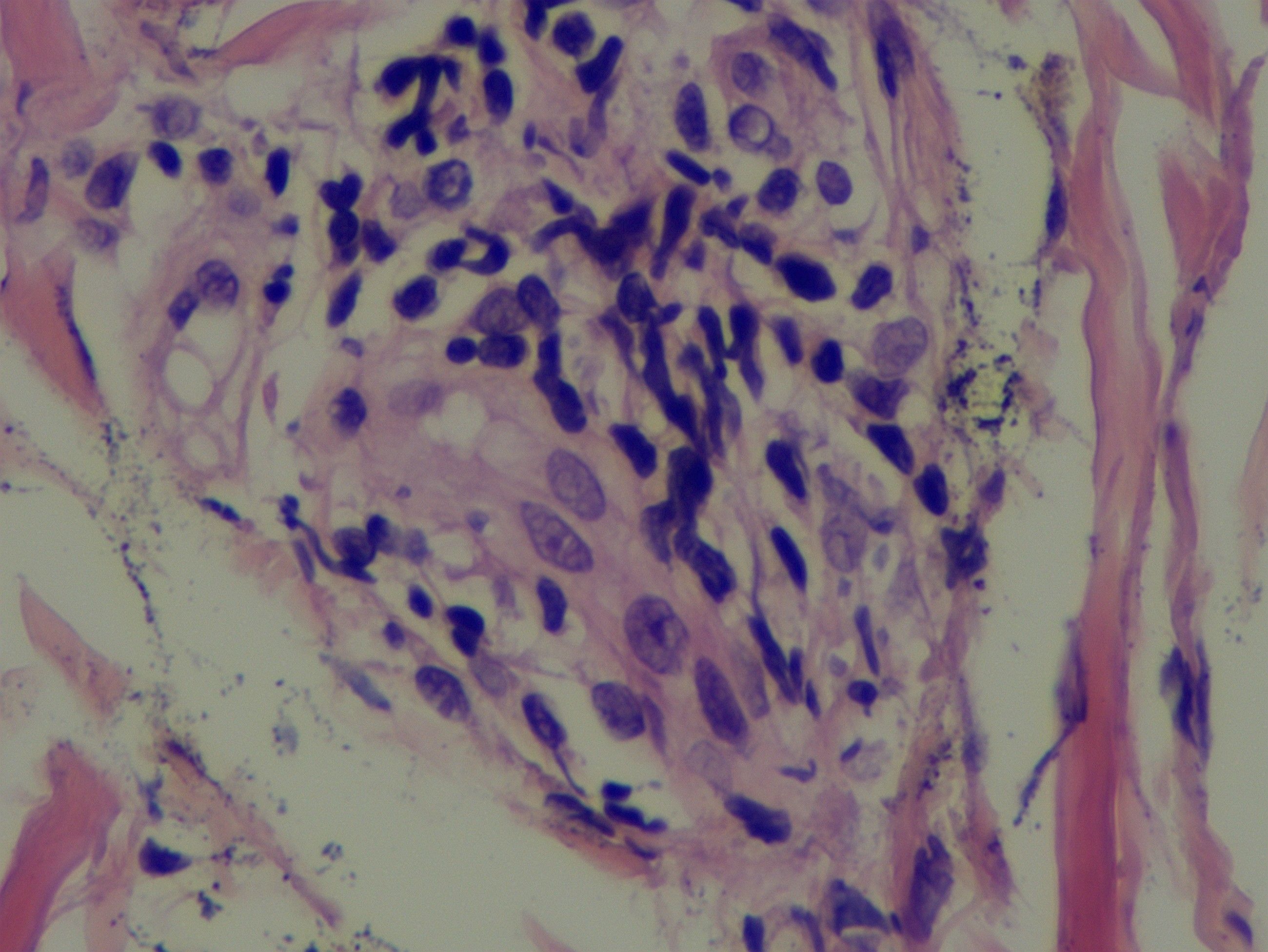 Microscopic image showing a cluster of dark purple stained cells within a tissue matrix. The cells vary in size and shape, with some circular and some elongated. Surrounding areas have a lighter, pinkish hue.