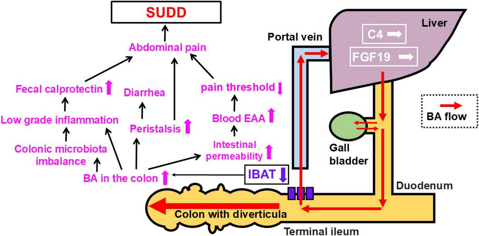 Diagram showing the pathophysiology of symptomatic uncomplicated diverticular disease (SUDD). The image highlights links between inflammation, diarrhea, abdominal pain, colonic microbiota imbalance, and bile acid (BA) flow. BA flows from the liver to the duodenum, gall bladder, terminal ileum, and colon with diverticula. Changes in intestinal permeability, blood EAA levels, peristalsis, and pain threshold are noted. Key terms such as fecal calprotectin and IBAT are labeled, indicating their roles in the condition.