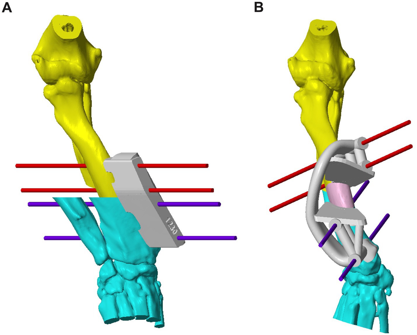 Illustration of two bone models labeled A and B. Model A displays a yellow bone with a gray rectangular attachment and multiple red and purple lines intersecting it. Model B shows a similar yellow bone with a curved gray structure and intersecting red and purple lines. Both models include blue bone segments at the bottom.
