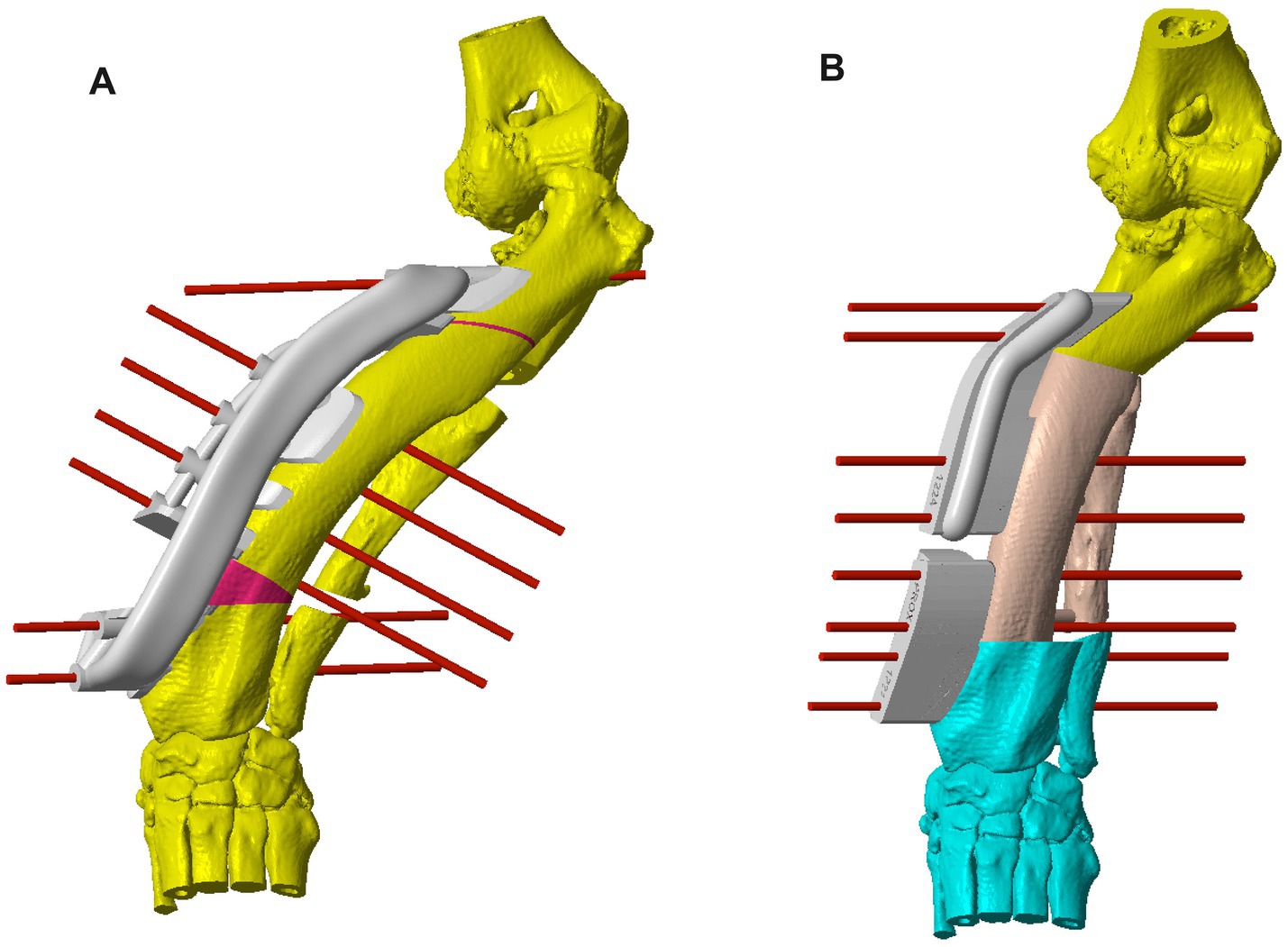 Diagram showing two views labeled A and B of a surgical implant on a antebrachium model. Both views display a gray implant attached to a yellow bone with red connecting lines. View A features a full implant secured with red lines, while view B shows additional blue and brown sections on the lower part of the bone, indicating enhanced fixation.
