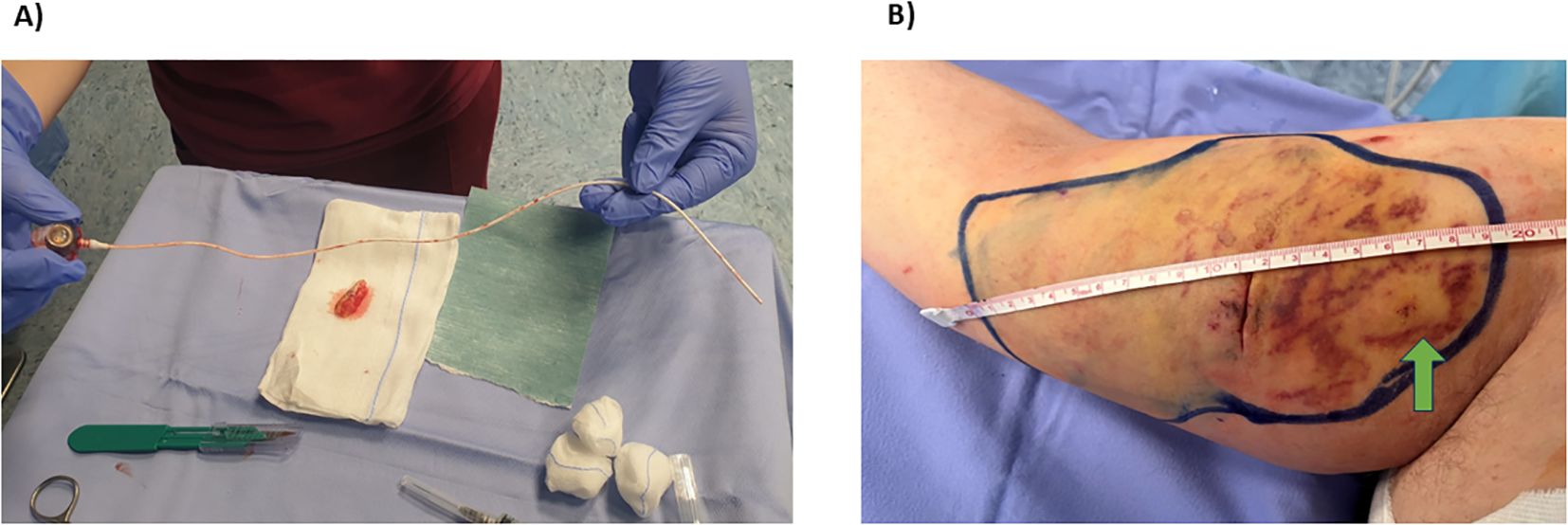 A) Gloved hands hold a flexible medical device over a surgical tray with a scalpel, syringe, and gauze pads. B) A leg with a marked and bruised area is measured with a tape, featuring a green arrow pointing to the section.