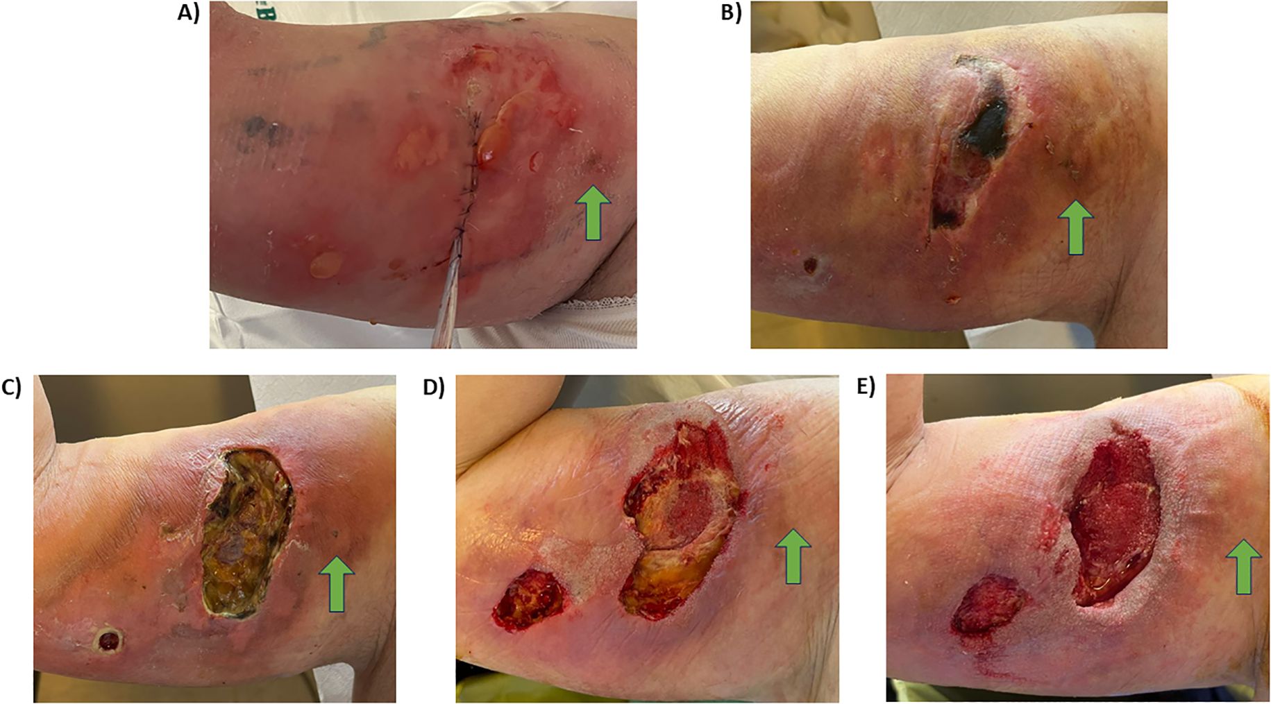 Series of five images depicting the progression of a severe skin wound on an arm. A) Fresh wound with stitches and inflammation. B) Dark, necrotic tissue forming. C) Yellow, necrotic tissue developing in an ulcer. D) Wound is partially cleaned, showing red and yellow tissue. E) Continuing healing progress with red tissue and reduced necrosis. Green arrows indicate affected areas.