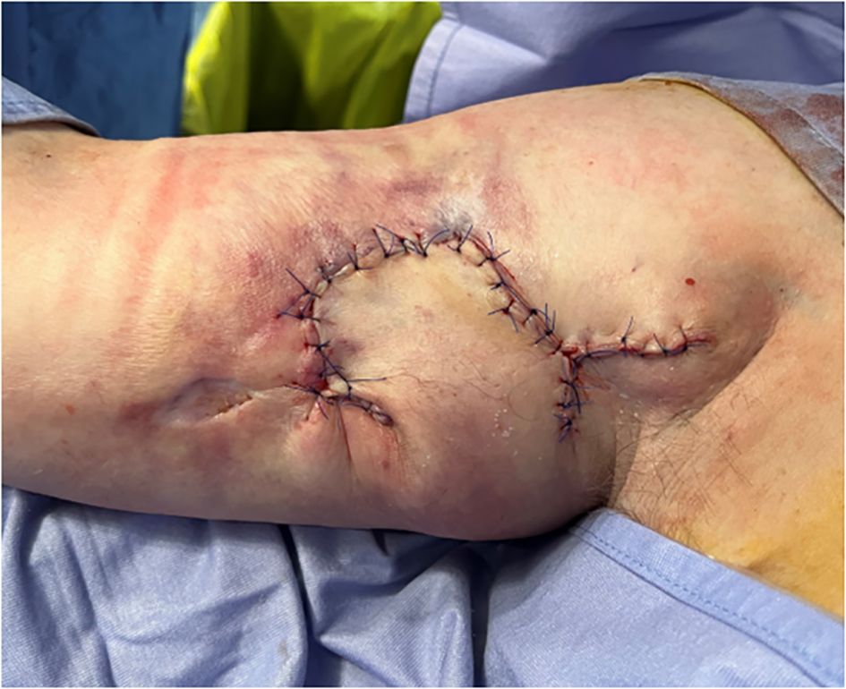 A close-up of a human limb with a sutured wound displaying multiple stitches in a zigzag pattern. The skin around the stitches appears slightly swollen and discolored, indicating recent surgery or injury. The limb rests on a blue fabric surface.