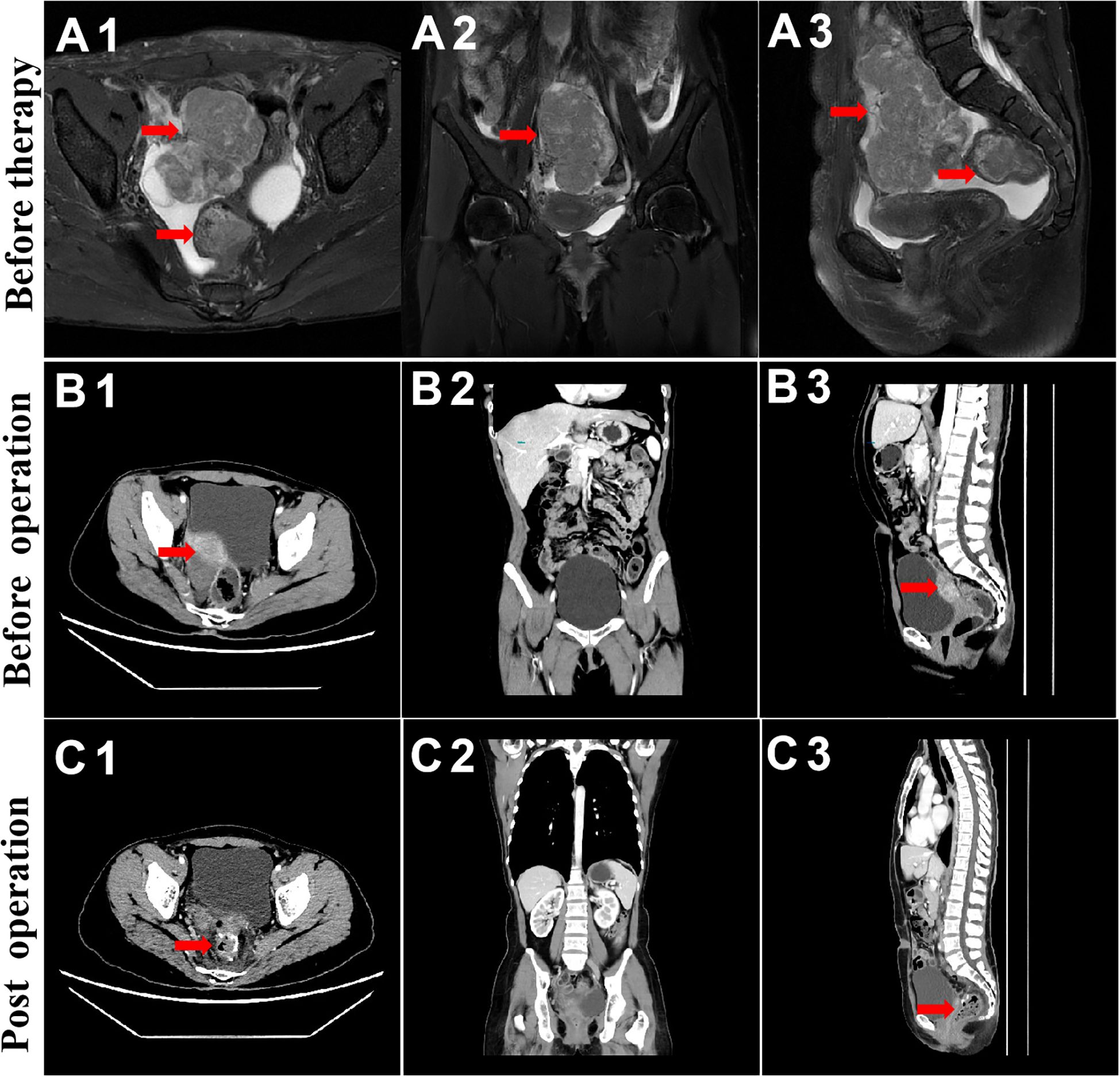MRI and CT scan images showing a pelvic mass in different stages of treatment. The top row (A1, A2, A3) shows images before therapy with the mass prominently highlighted by red arrows. The middle row (B1, B2, B3) features images before operation, showing the mass marked by arrows. The bottom row (C1, C2, C3) displays post-operation images where the mass is reduced or absent, as indicated by arrows. Each column represents a different plane of view: axial, coronal, and sagittal.