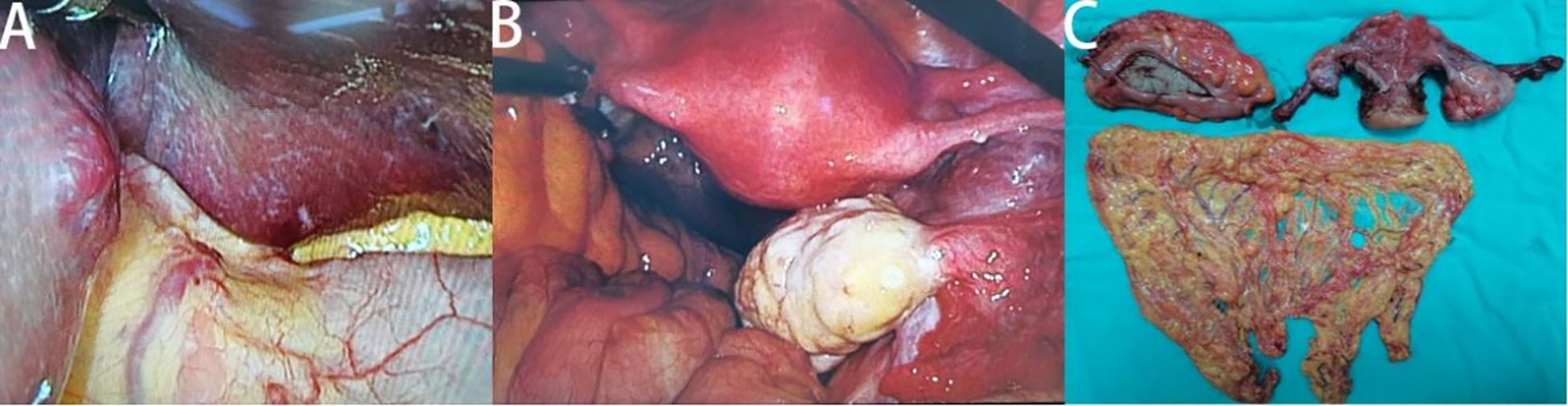 Three-panel medical images: Panel A shows the liver with visible lesions. Panel B shows an intra-abdominal view with a large white mass. Panel C displays excised tissue specimens on a blue background.