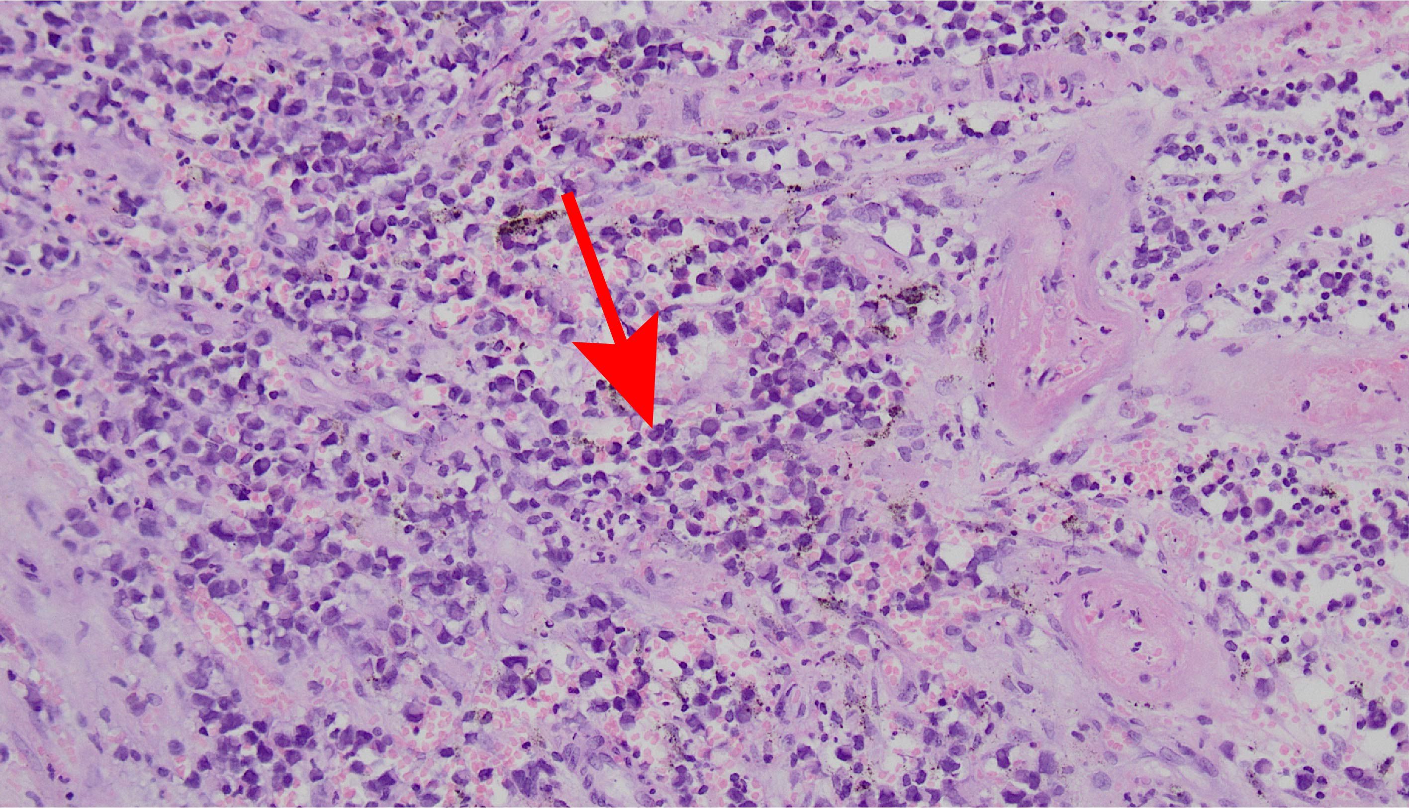 Microscopic image of infected tissue showing numerous small, round purple cells indicating inflammation, surrounded by diffuse pinkish areas, typicallyrepresenting stained connective tissue.