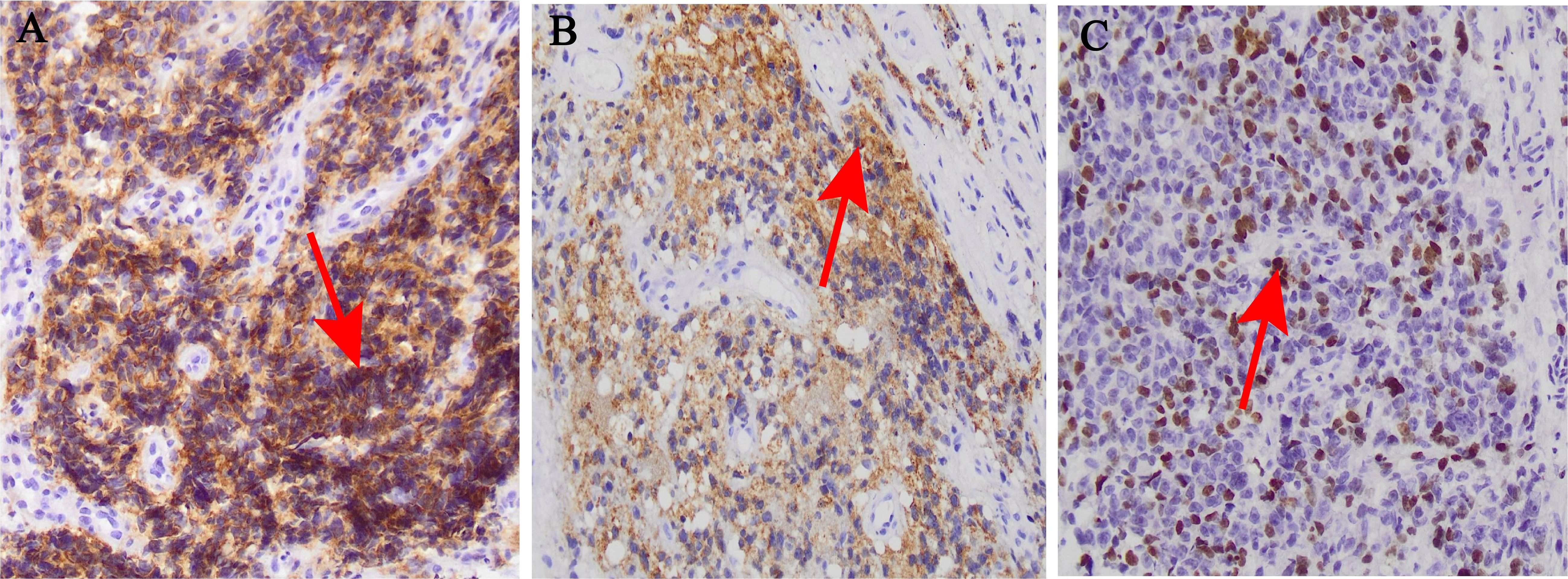 Histological slides labeled A, B, and C show cellular structuresstained with varying intensities of brown and purple. Slide A has dense brown staining, indicating high expression of a specific protein. Slide B shows moderate brown staining with some clear areas.Slide C displays lighter and more diffuse brown staining, showing low protein expression. Each panel highlights different levels of protein presence within tissue samples.