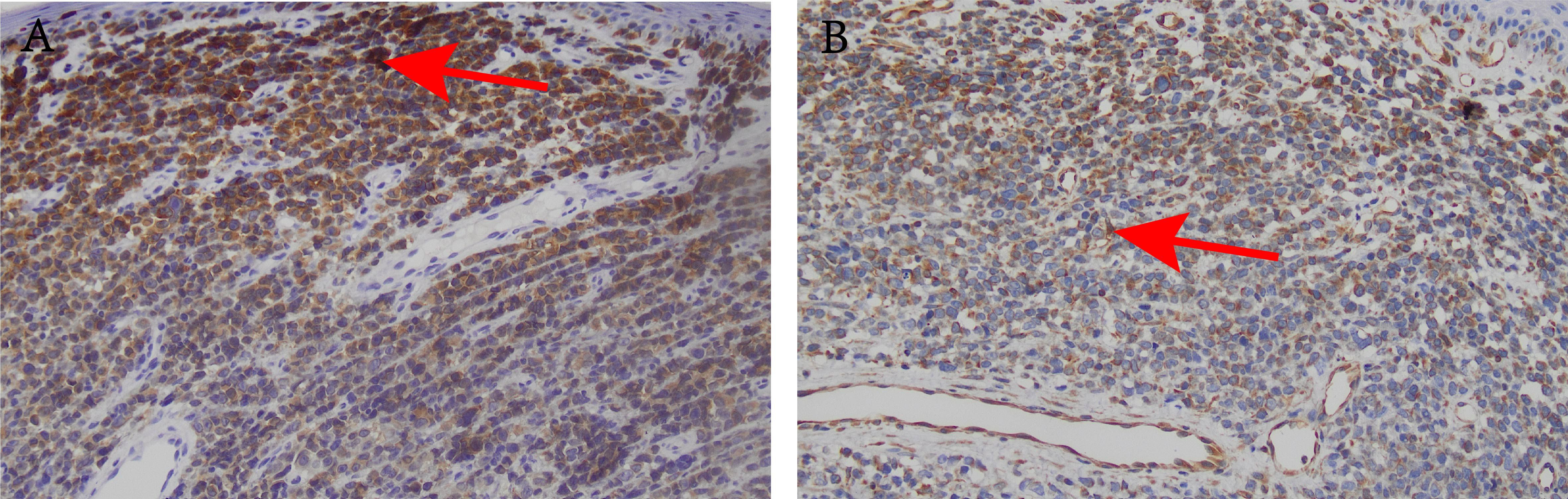 Histological comparison of tissue samples labeled A and B. Sample A shows densely packed brown-stained cells, while sample B has a less dense arrangement with lighter staining. Both images display cell structures undera microscope.
