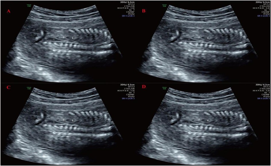 Ultrasound images labeled A, B, C, and D show sections of the gastrointestinal tract. Each image displays the characteristic layered appearance of the intestine, with arrows in A and C indicating specific areas of interest.
