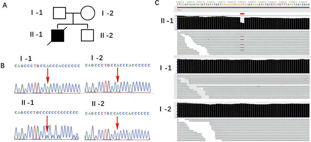 Pedigree and genetic analysis of family members. Panel A shows a pedigree chart with affected individual II-1 shaded. Panel B displays DNA sequence chromatograms for individuals I-1, I-2, II-1, and II-2 with arrows indicating a specific nucleotide change. Panel C presents a sequencing alignment for the same individuals, highlighting differences in nucleotide sequences.