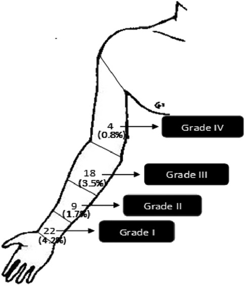 Diagram of an arm labeled with four grades. Grade I, covering the hand, shows 22 cases (4.2%). Grade II, on the forearm, has 9 cases (1.7%). Grade III, on the upper arm, shows 18 cases (3.5%). Grade IV, near the shoulder, has 4 cases (0.8%).