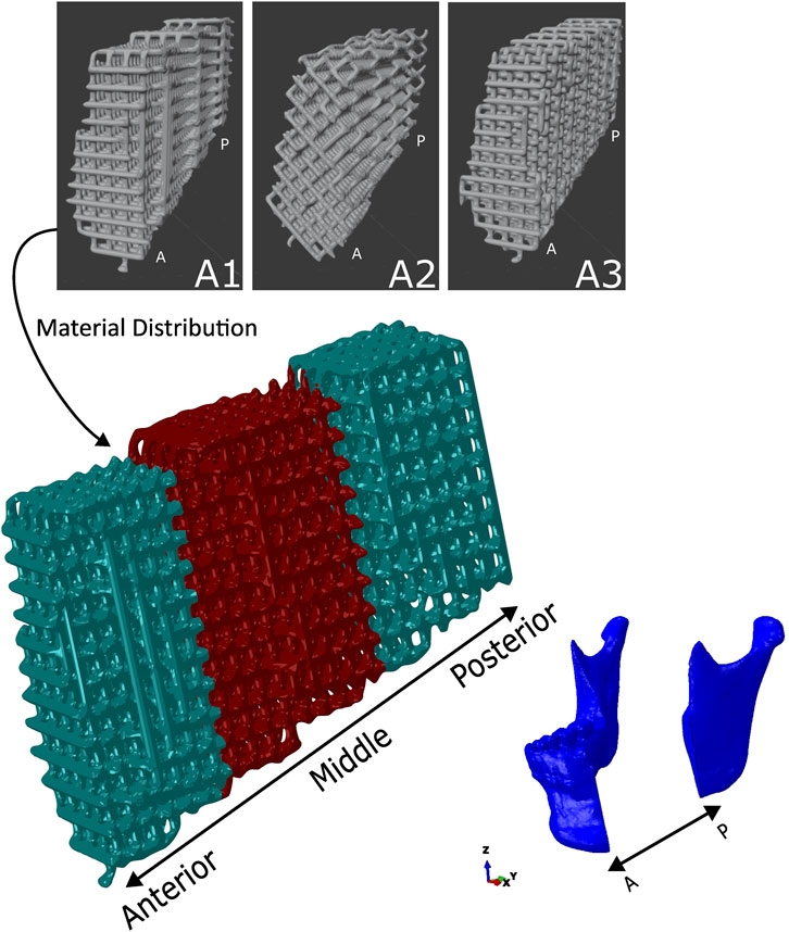 Illustration showing three lattice structures labeled A1, A2, and A3, with anterior (A) and posterior (P) orientations. Below, a colored 3D model illustrates material distribution in anterior, middle, and posterior sections, marked with blue and red. A directional axis in blue shows an A to P orientation.