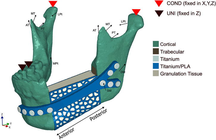 Diagram of a mandible model showing various regions: cortical (green), trabecular (brown), titanium (light blue), titanium/PLA (dark blue), and granulation tissue (gray). Red and black triangles indicate fixed points in X, Y, Z axes. Labels like LPt, MPT, and DM point to specific areas. Anterior and posterior directions are marked. A 3D axis is displayed.