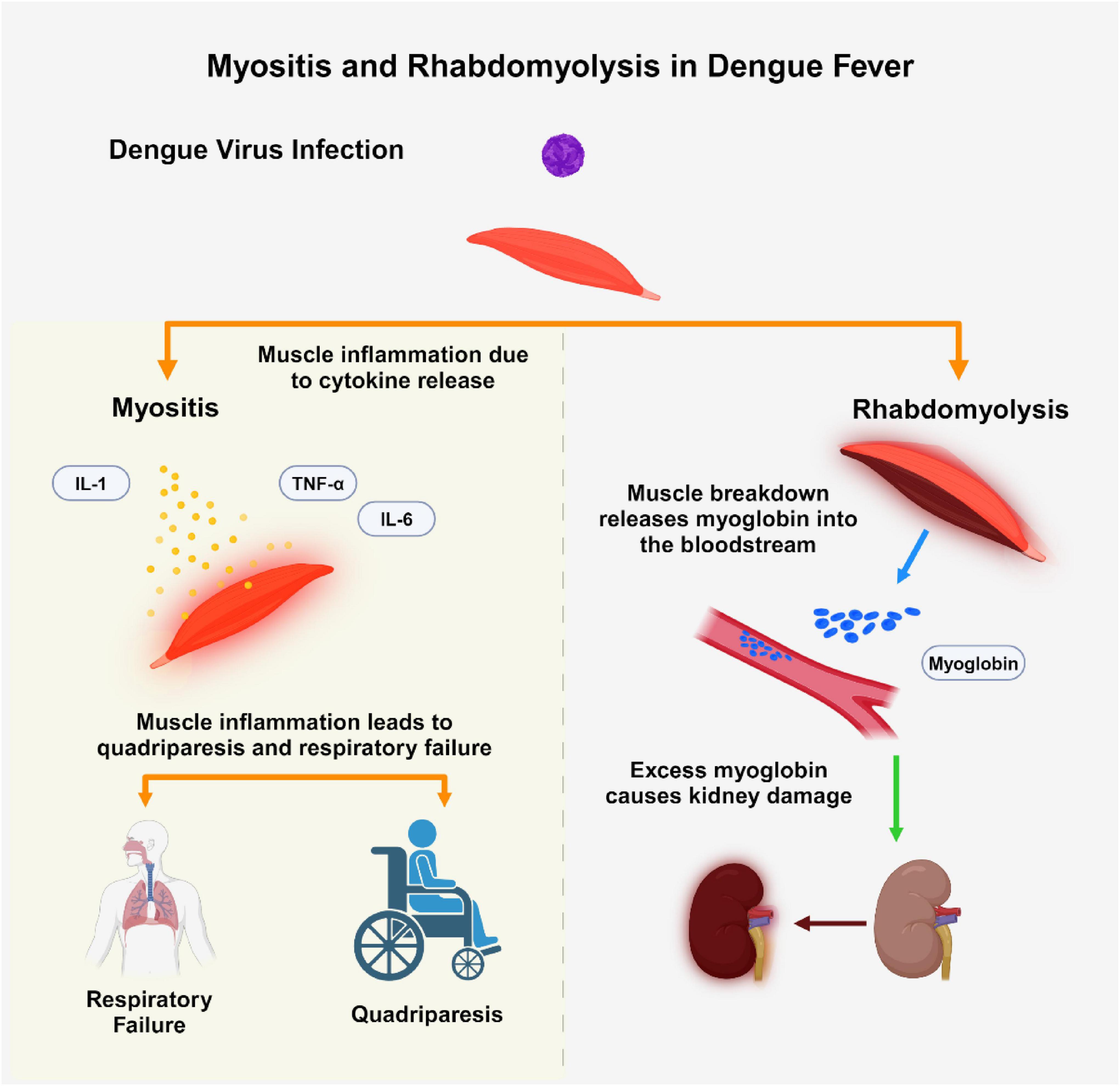 Illustration showing Myositis and Rhabdomyolysis in Dengue Fever. It details muscle inflammation due to cytokines (IL-1, TNF-alpha, IL-6) leading to quadriparesis and respiratory failure. Rhabdomyolysis causes muscle breakdown, releasing myoglobin, which can damage kidneys.