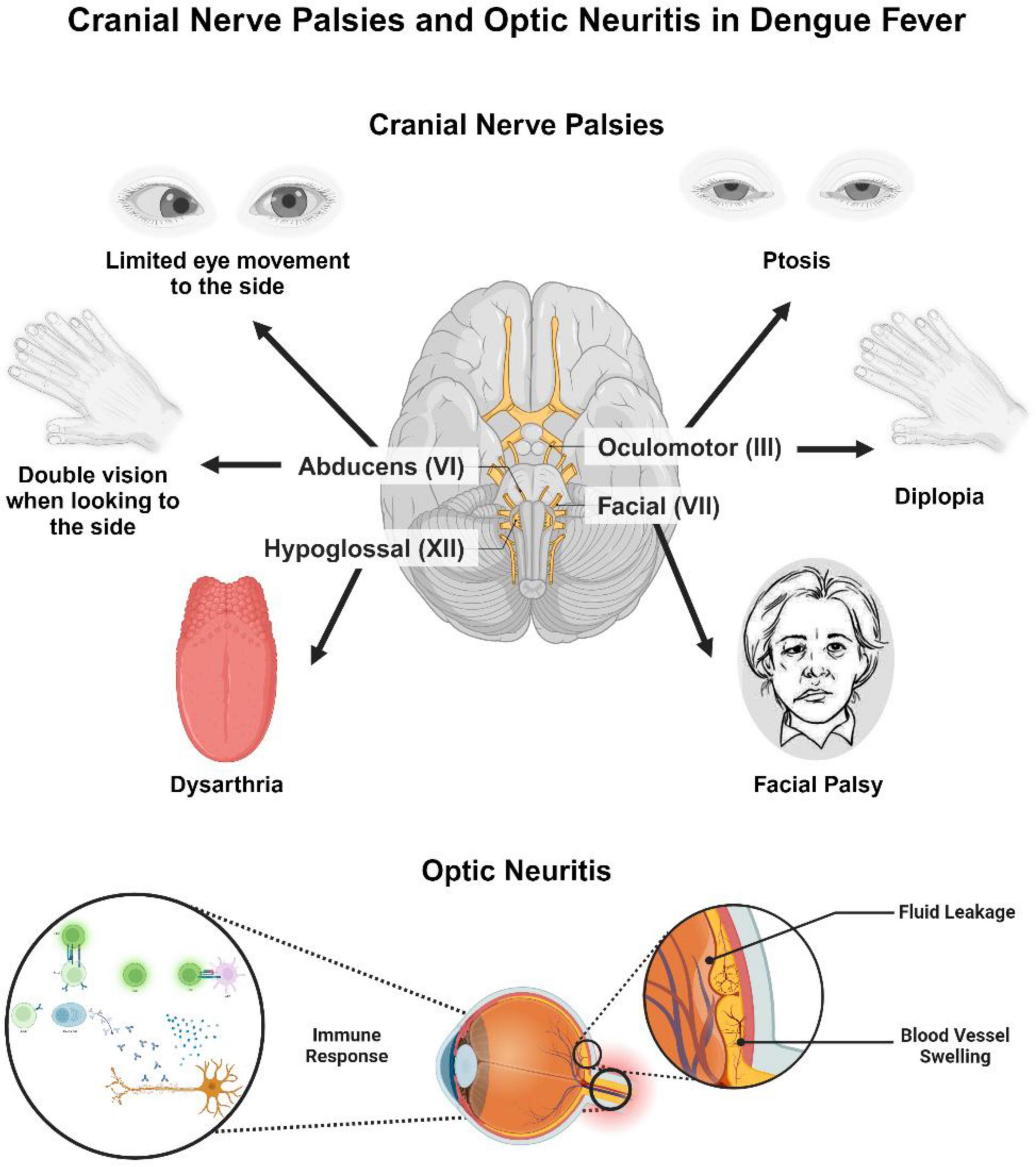 Diagram illustrating cranial nerve palsies and optic neuritis in dengue fever. Includes effects such as limited eye movement, ptosis, diplopia, dysarthria, and facial palsy linked to cranial nerves III, VI, VII, and XII. Shows optic neuritis with sections highlighting immune response, fluid leakage, and blood vessel swelling.