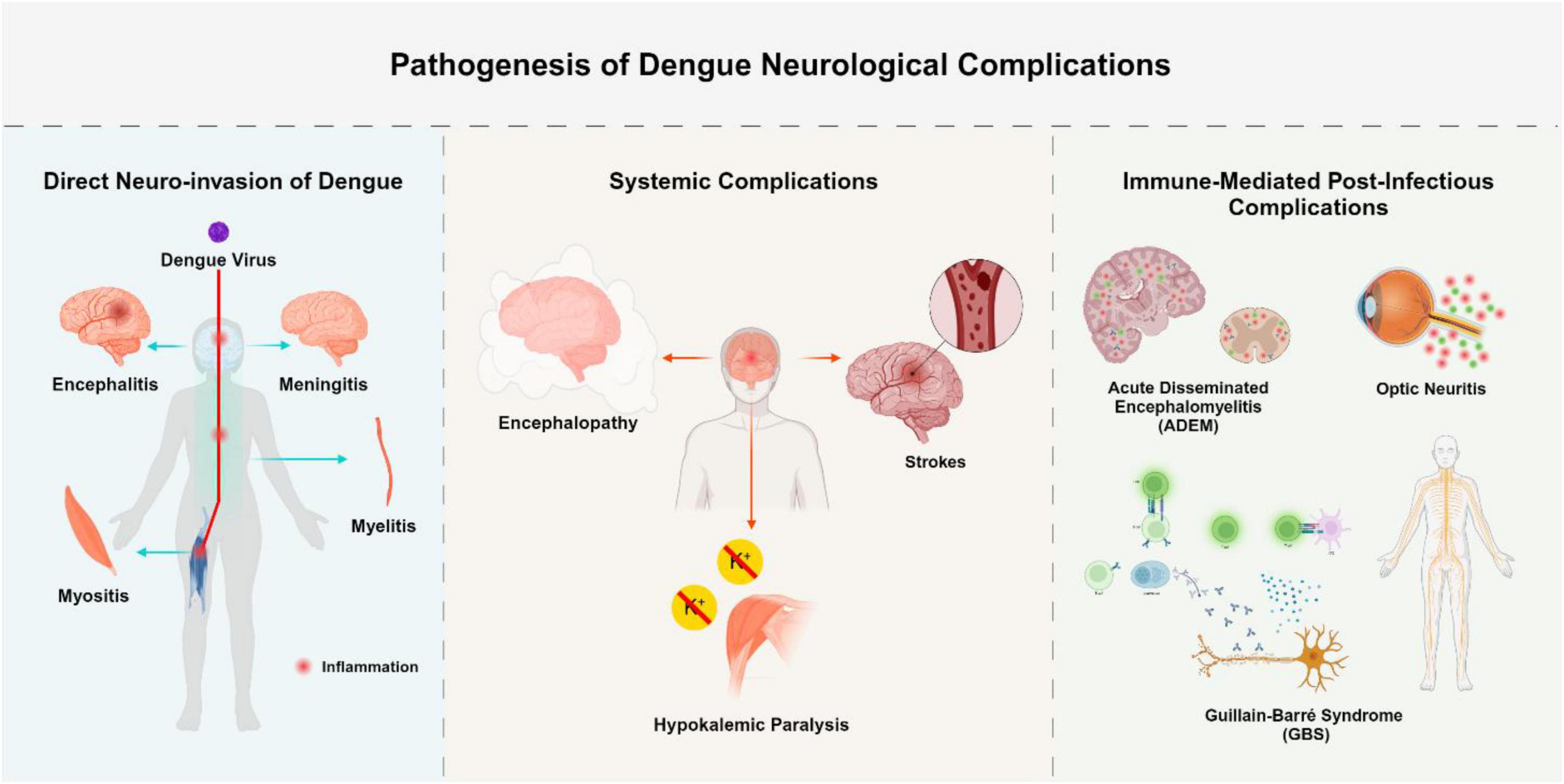 Diagram illustrating the pathogenesis of dengue neurological complications. It is divided into three sections: Direct Neuro-invasion of Dengue, showing encephalitis, meningitis, myelitis, and myositis; Systemic Complications, depicting encephalopathy, strokes, and hypokalemic paralysis; and Immune-Mediated Post-Infectious Complications, featuring acute disseminated encephalomyelitis (ADEM), optic neuritis, and Guillain-Barré syndrome (GBS).