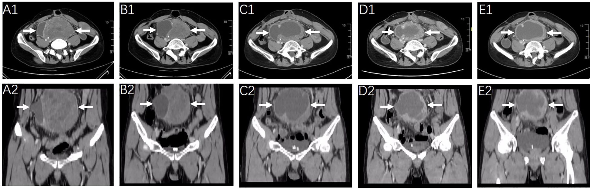 CT scan images showing axial (A1-E1) and coronal (A2-E2) views of a pelvic mass. Each image is identified by labels A1 to E1 for axial views and A2 to E2 for coronal views. White arrows point to the location of abnormalities or masses within the pelvic region across different images.