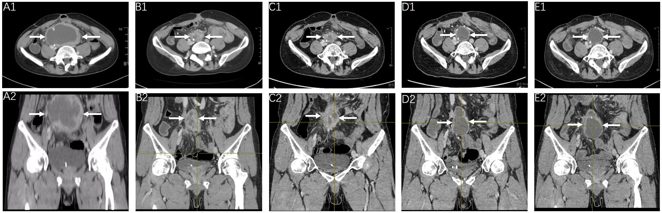 A series of CT scans showing axial views (A1, B1, C1, D1, E1) and corresponding coronal views (A2, B2, C2, D2, E2). Each image has arrows indicating areas of interest, possibly highlighting a specific organ or pathology. The scans display anatomical details of the pelvic region.