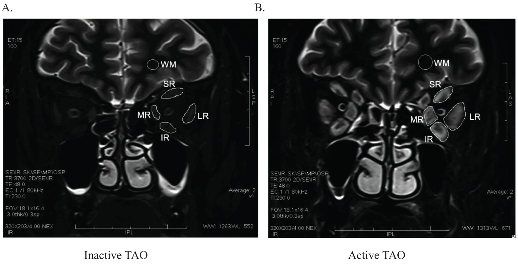 Two MRI scans compare inactive and active thyroid-associated ophthalmopathy (TAO). Image A shows inactive TAO with labeling of muscles including superior rectus, medial rectus, and inferior rectus. Image B shows active TAO, with visible enlargement of the same muscles.