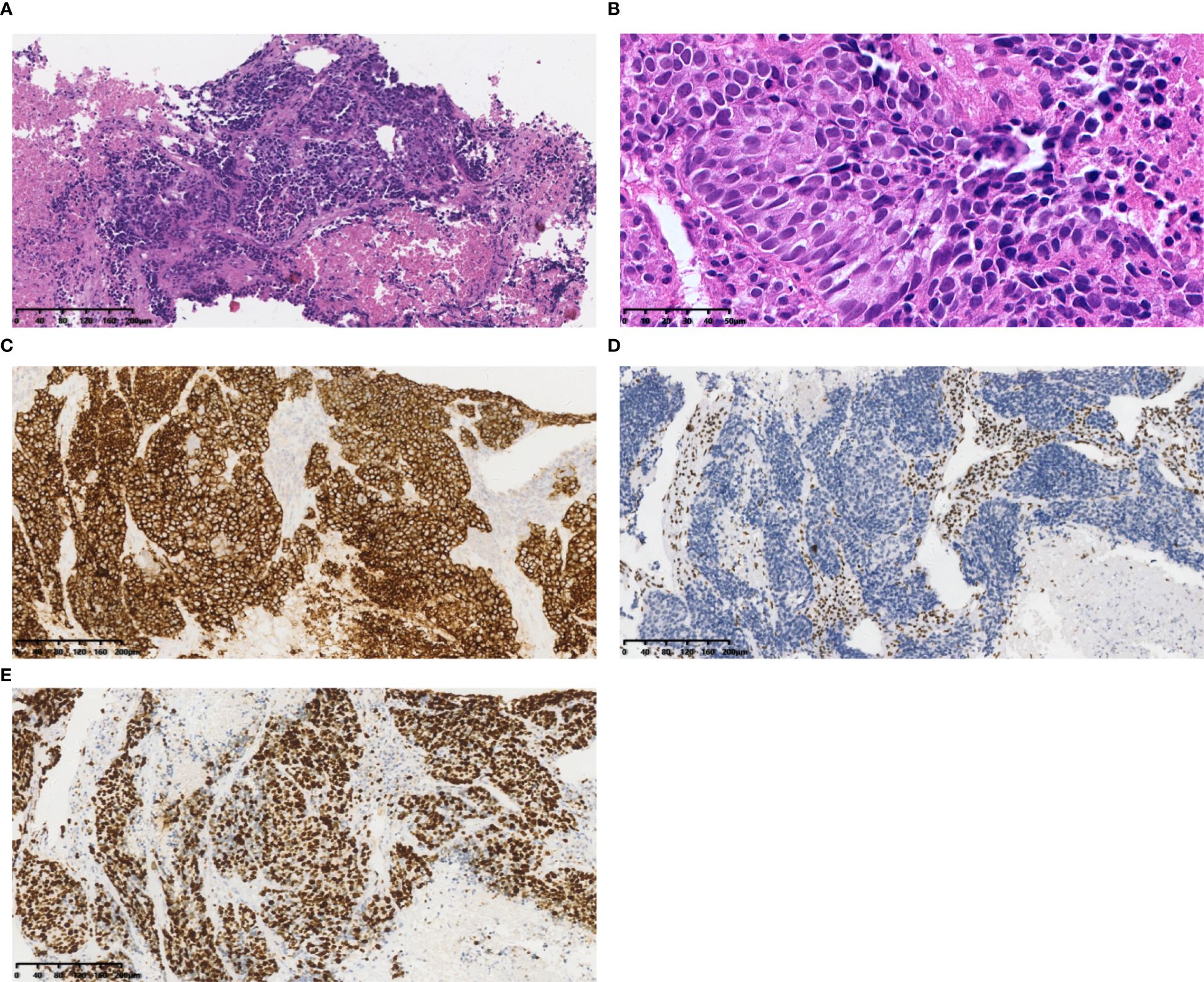 Five panel image showing different histological slides of tissue samples. Panel A and B display hematoxylin and eosin stained slides highlighting cell morphology with varying magnifications. Panels C, D, and E show immunohistochemical staining, revealing different patterns and densities of marker expression in brown and blue hues.