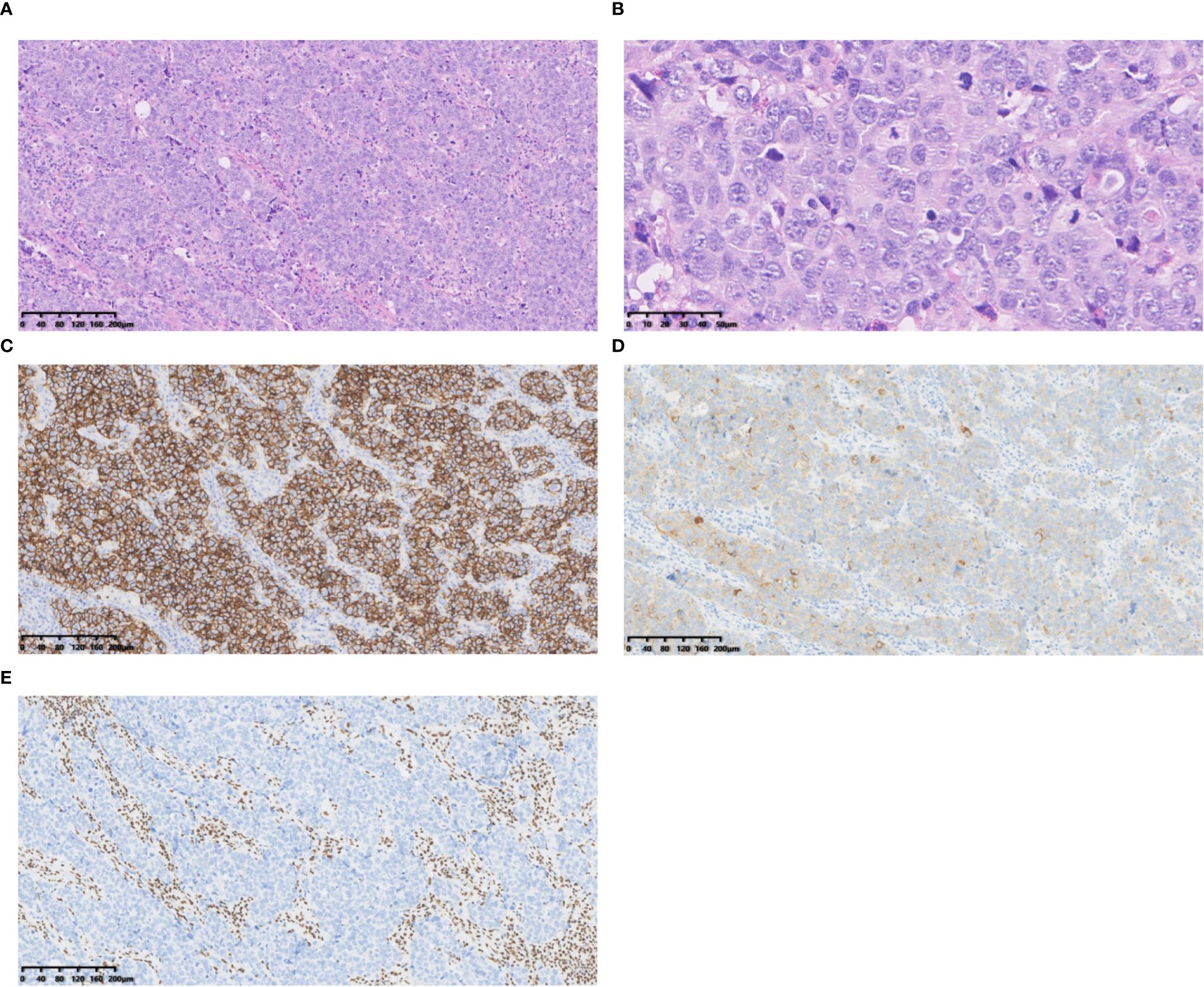A panel of five histological images labeled A through E. A shows a diffuse sheet of cells with a light purple background. B presents a close-up of densely packed cells with visible nuclei on a purple background. C depicts a tissue section with prominent brown staining, indicating the presence of a specific protein. D shows a lightly stained tissue with scattered brown spots on a lighter background. E illustrates a tissue with scattered brown staining against a pale background, suggesting sporadic protein expression. Scale bars are visible in each image.
