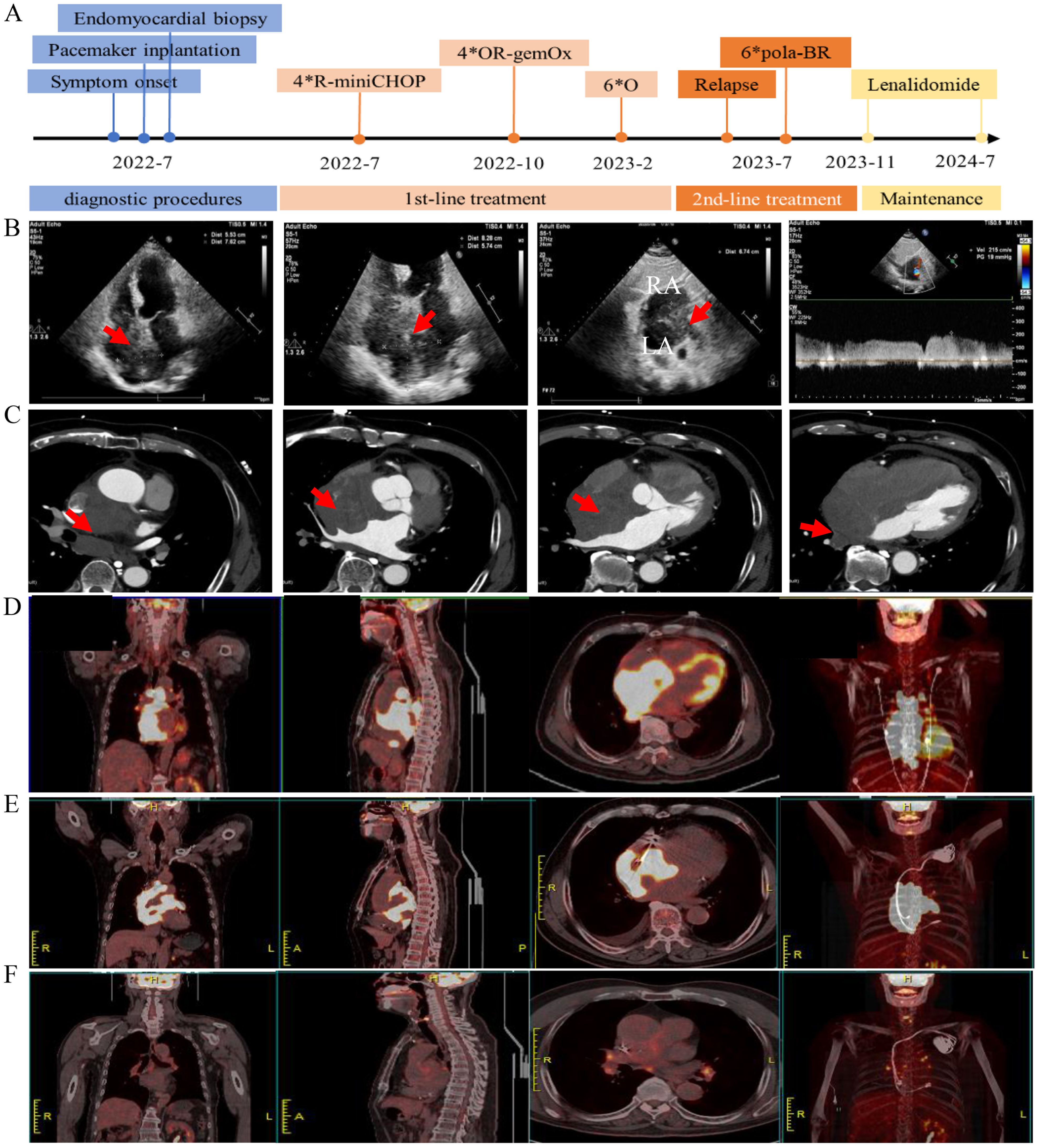 A series of medical images display a patient's treatment timeline and diagnostic scans. Panel A shows a timeline with key events and treatments, including endomyocardial biopsy, pacemaker implantation, and drug therapy courses. Panels B and C include various echocardiogram and CT images highlighting specific areas with red arrows. Panels D, E, and F show PET scans in different planes, illustrating changes over time in the chest and abdomen, indicating areas of medical interest.