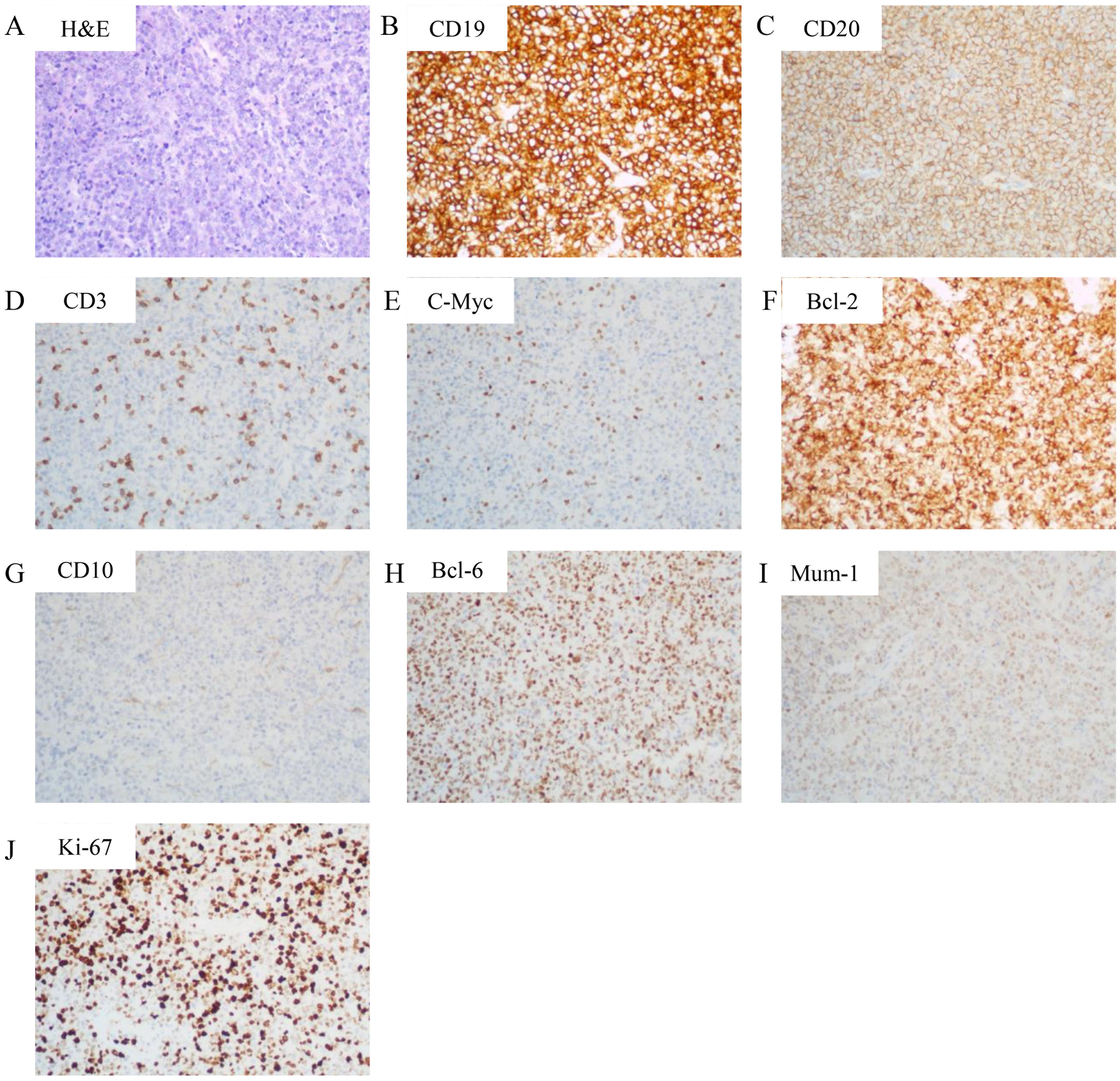 A collage of immunohistochemistry images showing various biomarkers in tissue samples. Panel A shows H&E staining. Panels B to J display stained markers: CD19, CD20, CD3, C-Myc, Bcl-2, CD10, Bcl-6, Mum-1, and Ki-67, highlighting different protein expressions in the samples. Each marker displays varying levels of staining intensity and distribution.