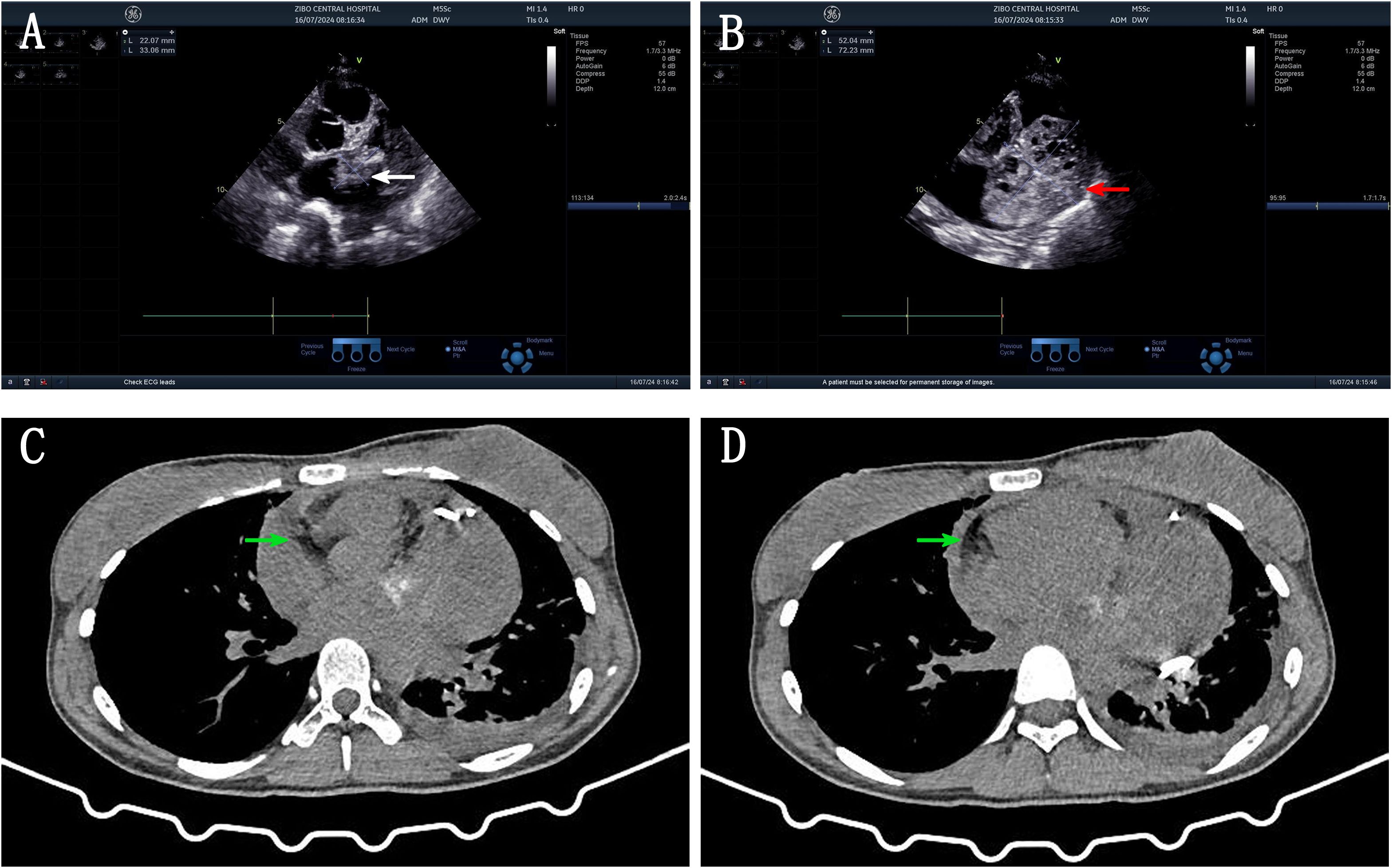 Ultrasound and CT images showing abnormal findings. Panel A, an ultrasound image, highlights a structure with a white arrow. Panel B shows another ultrasound with a red arrow indicating a different area. Panel C, a CT scan, marks a region with a green arrow. Panel D, another CT scan, also highlights a section with a green arrow. The images are used for diagnostic purposes likely related to a medical condition.