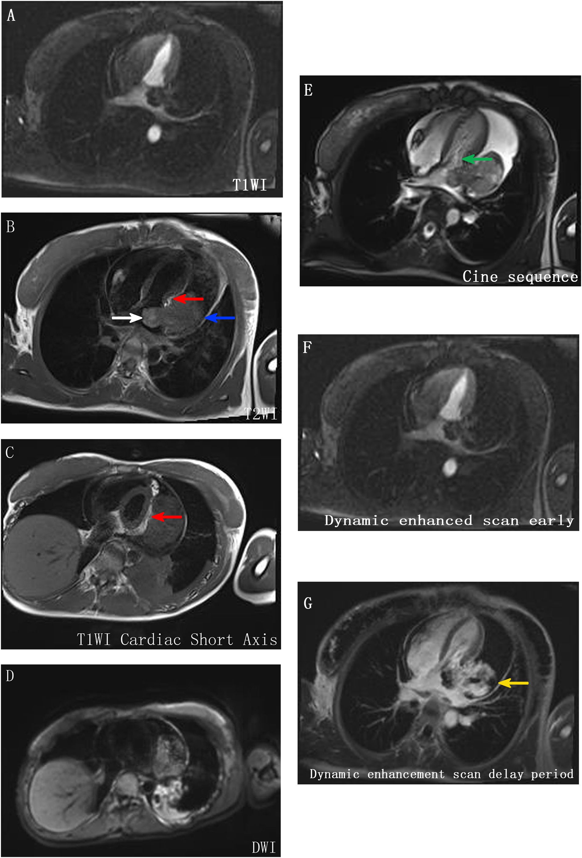 MRI images of the heart show different sequences and enhancements. Panel A shows a T1-weighted image. Panel B, a T2-weighted image, has arrows indicating specific areas. Panel C shows a cardiac short axis view. Panel D depicts a diffusion-weighted image. Panel E displays a cine sequence with a green arrow indicating a focal spot. Panels F and G show dynamic enhanced scans at early and delay periods, respectively, with arrows highlighting regions of interest.