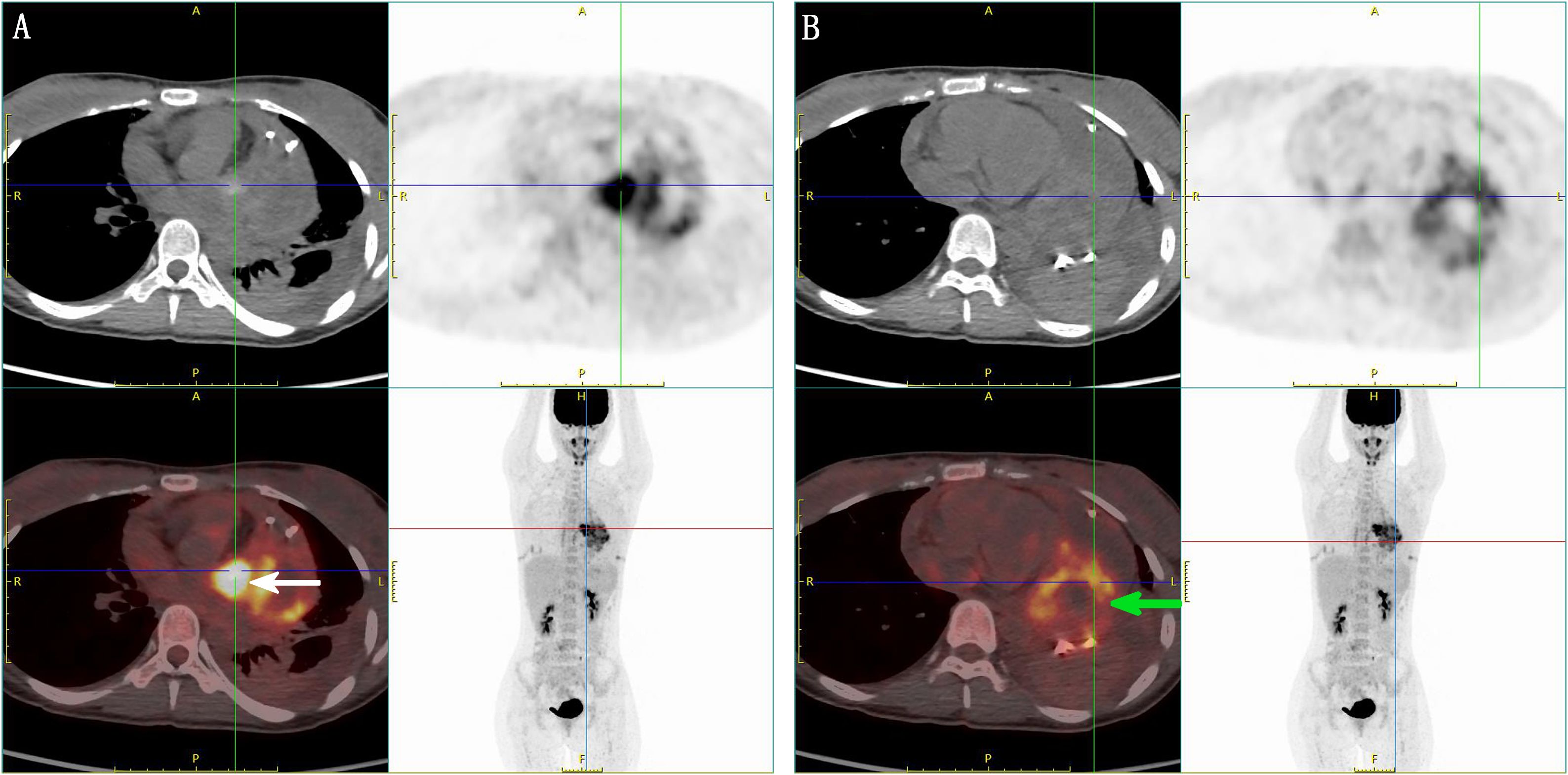 Comparison of PET-CT images in two panels labeled A and B. Panel A shows cross-sectional images with a prominent bright spot indicated by a white arrow, suggesting high uptake in a specific area. Panel B reveals similar cross-sectional images with a green arrow pointing to another bright area of high uptake. Both panels include grayscale and colorized images, displaying anatomical and metabolic information.