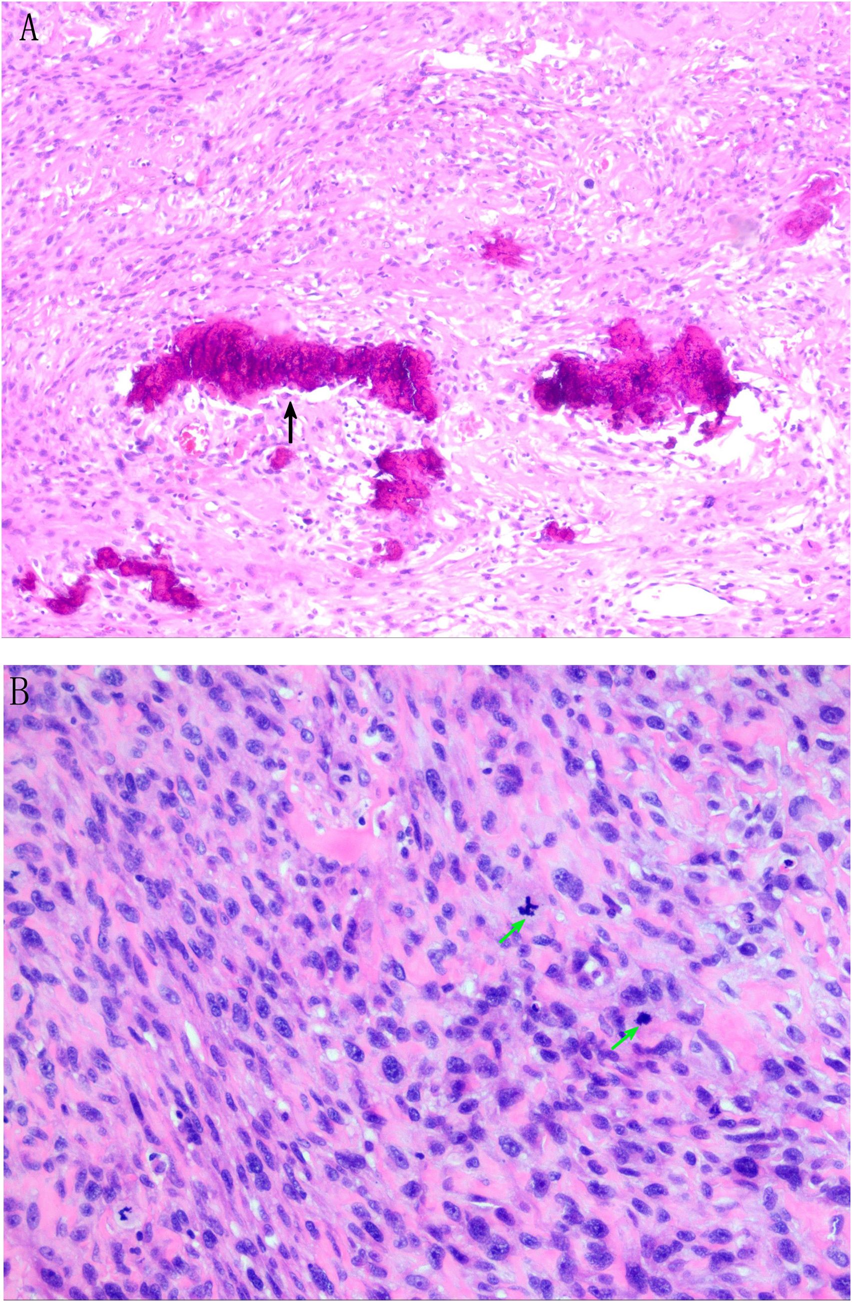 Panel A shows a histological image with dense areas stained dark purple, indicated by a black arrow, amidst a lighter pink background. Panel B displays a similar tissue section, showing numerous densely packed, dark purple cells with two green arrows marking specific regions. Both images demonstrate cellular structures and staining patterns typical in microscopic pathology slides.