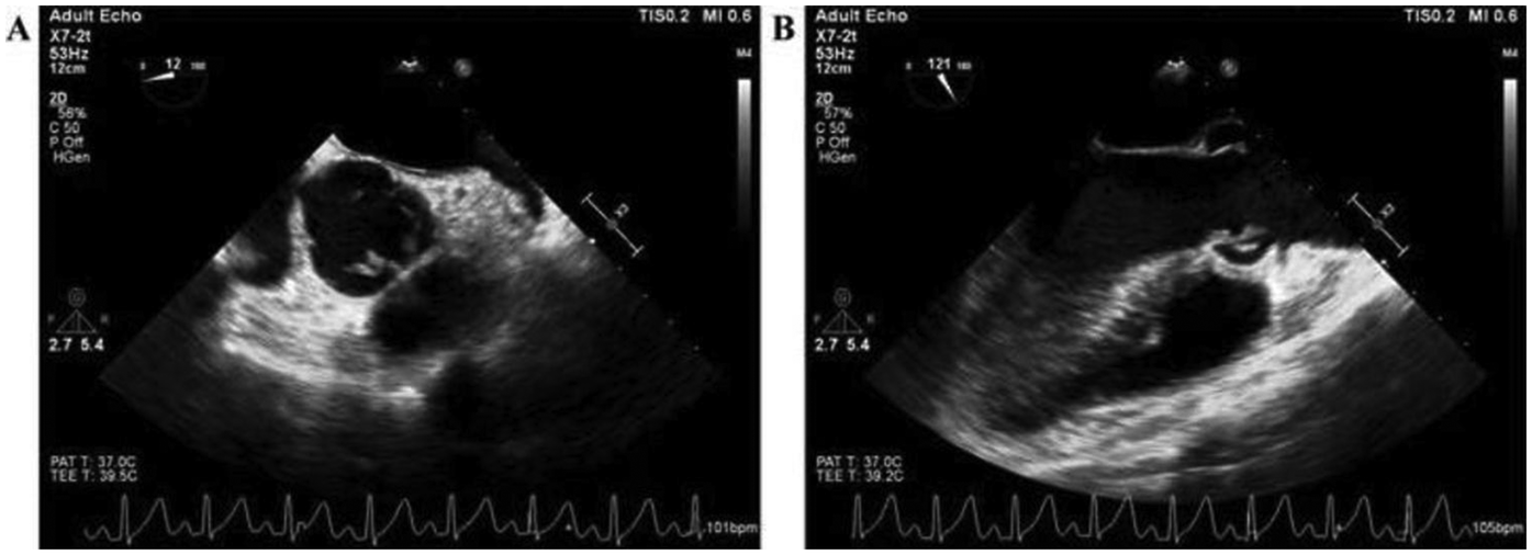Two echocardiogram images labeled A and B. Both show adult echocardiographic views with annotations indicating technical settings such as frequency, depth, and gain. Below each image, electrocardiogram (ECG) traces are visible, depicting heart rate fluctuations.
