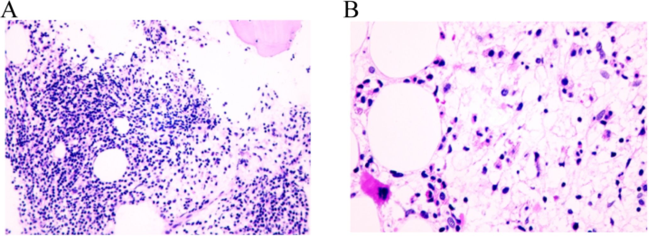 Microscopic images labeled A and B. Image A shows dense clusters of dark-stained cells on a light background, indicating high cellularity. Image B displays fewer, more widely spaced cells with larger clear spaces, suggesting lower cellularity or adipose tissue. Both images are stained to highlight cellular structures.