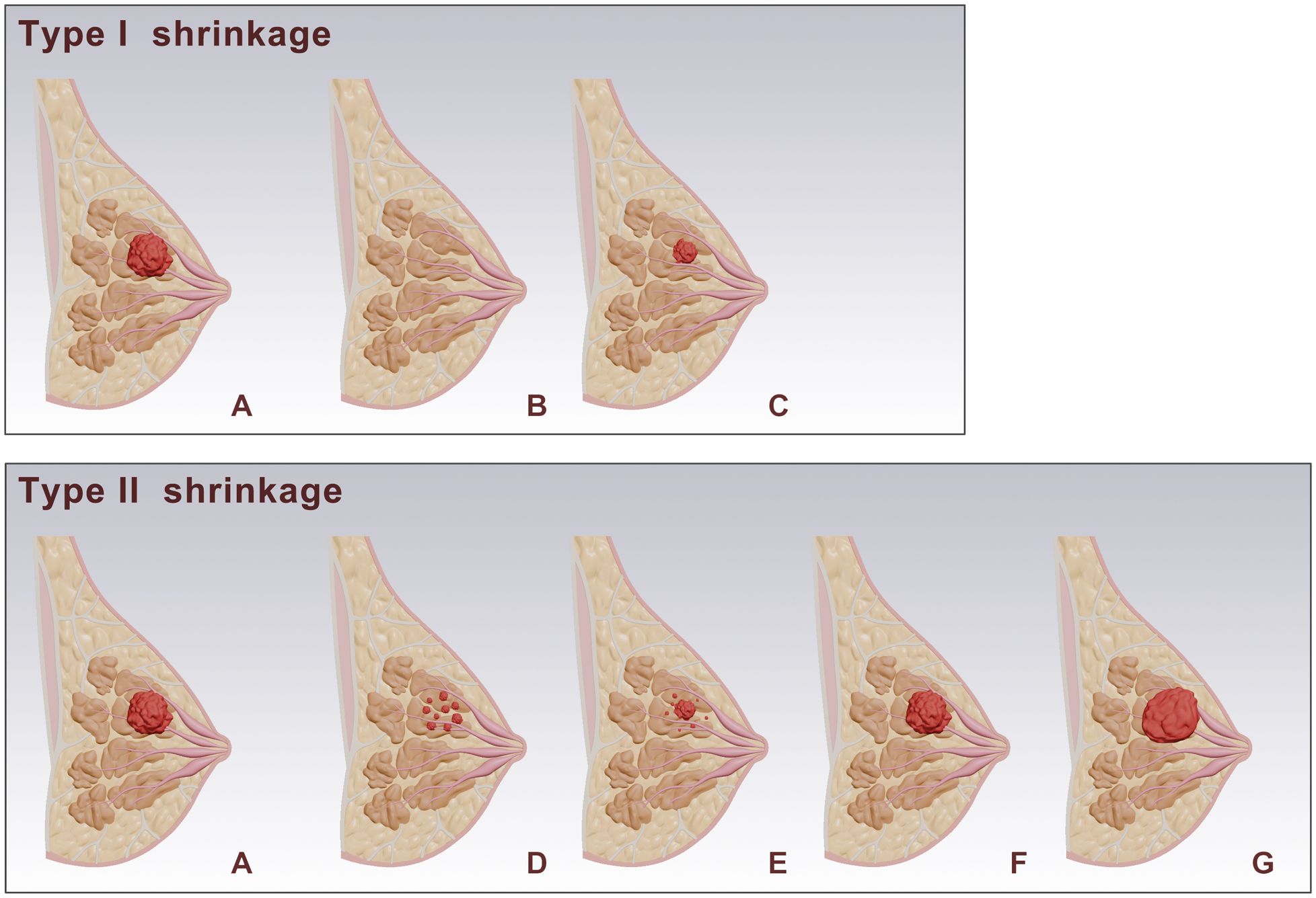 Illustration showing type I and type II breast tissue shrinkage. Type I includes images A, B, and C, depicting a tumor shrinking over time. Type II includes images A, D, E, F, and G, showing varying stages of tumor reduction and recurrence.