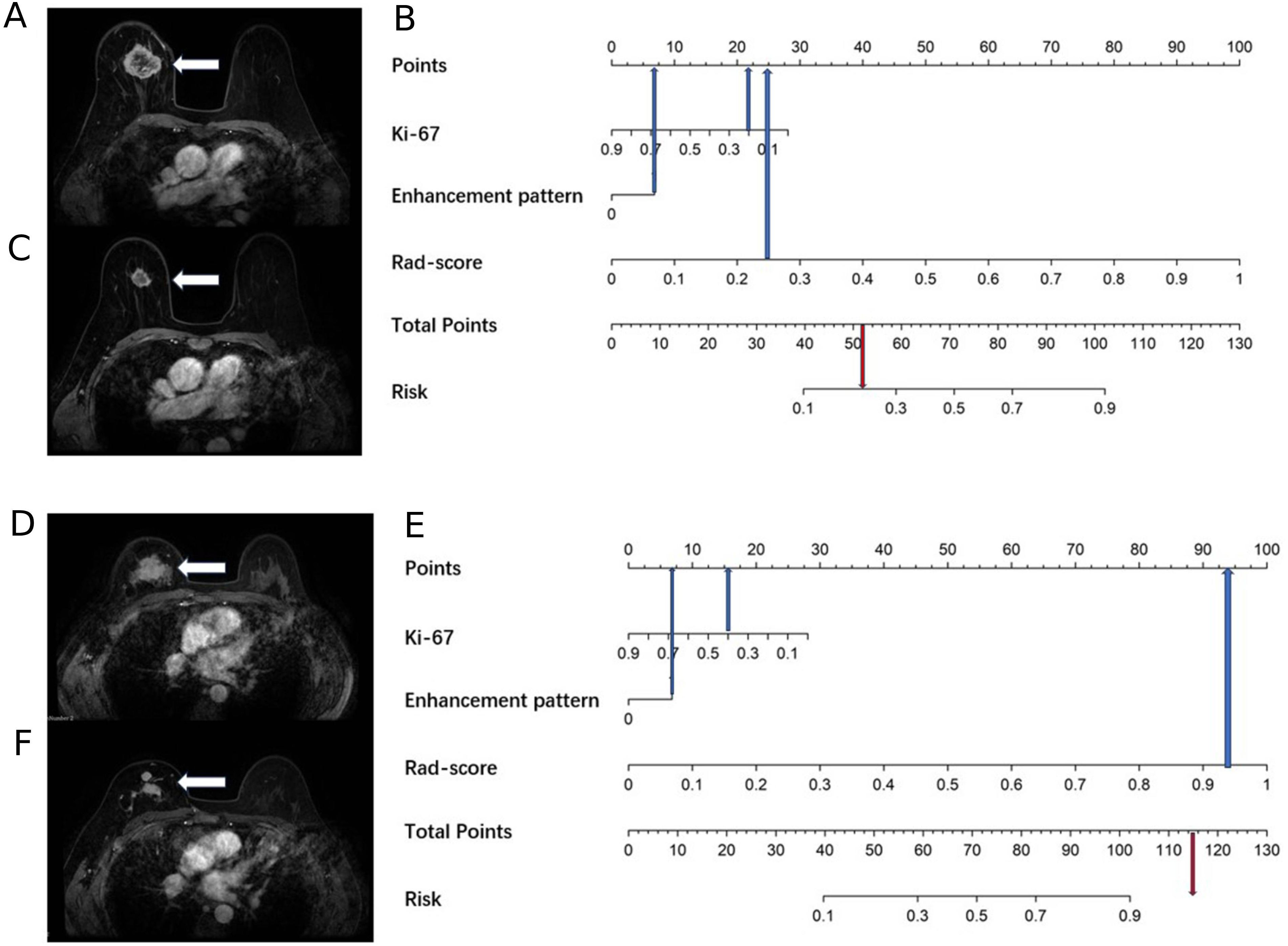 MRI images of breast tissue with arrows indicating areas of interest, labeled A, C, D, and F. Adjacent to each is a corresponding chart (B and E) displaying metrics: Points, Ki-67, Enhancement pattern, Rad-score, Total Points, and Risk. The charts show graphical markers indicating values for each metric.
