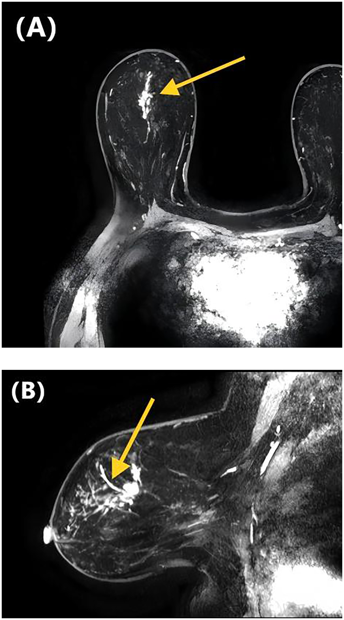 Magnetic resonance images of a breast showing invasive cancer in two views. Image (A) displays an axial-sectional view with an arrow pointing to a specific area. Image (B) shows a side view with an arrow indicating the linear distribution.