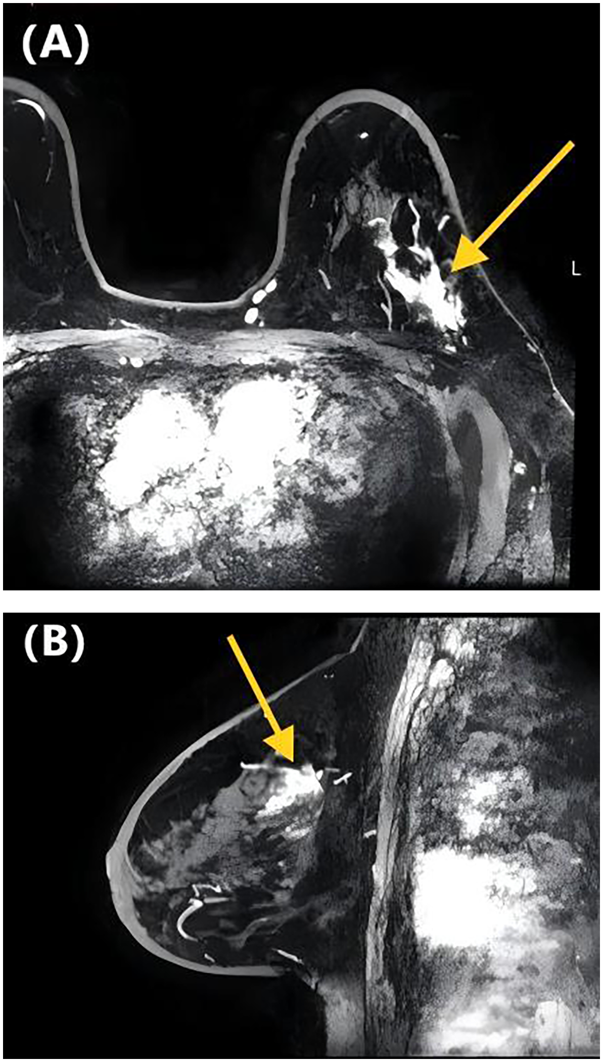 MRI scans of breast tissue. Image (A) displays an axial-sectional view and Image (B) presents a sagittal view,they show the non-mass-like enhancement with the focal distribution.