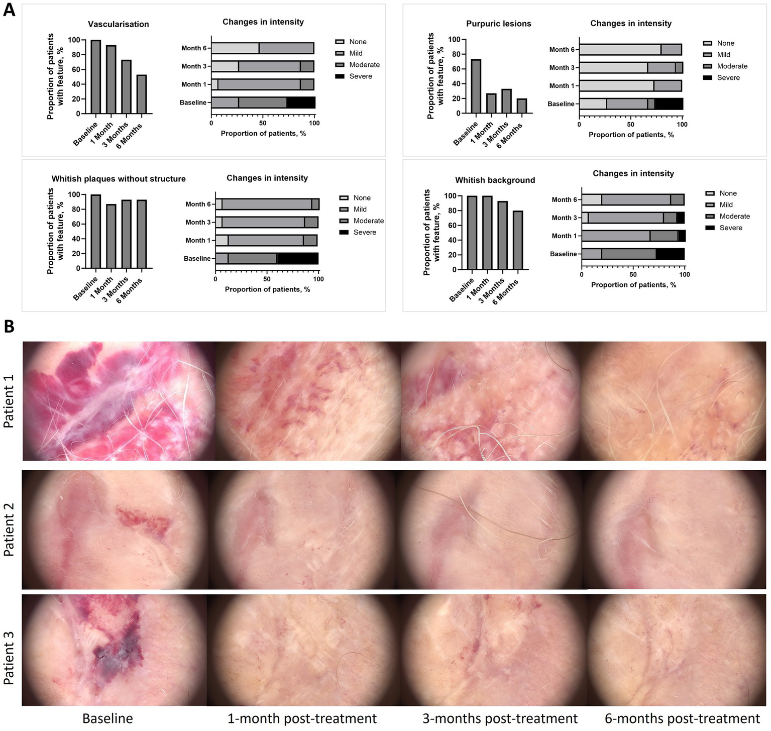 Panel A shows bar charts of skin conditions over time, including vascularization, purpuric lesions, whitish plaques, and background. Each chart depicts the changes in intensity from baseline to six months, categorized as none, mild, moderate, or severe. Panel B displays images of skin from three patients at baseline, one, three, and six months post-treatment, showing visible changes in skin appearance over time.