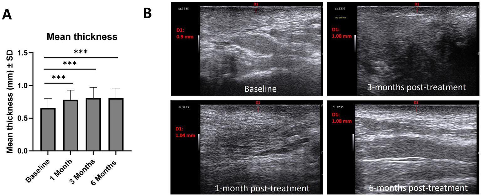 Bar chart and ultrasound images showing changes in mean thickness over time. Chart A displays increasing mean thickness from baseline to six months. Ultrasound images in section B show tissue thickness at baseline (0.9 mm), one month (1.04 mm), three months (1.08 mm), and six months (1.08 mm) post-treatment.