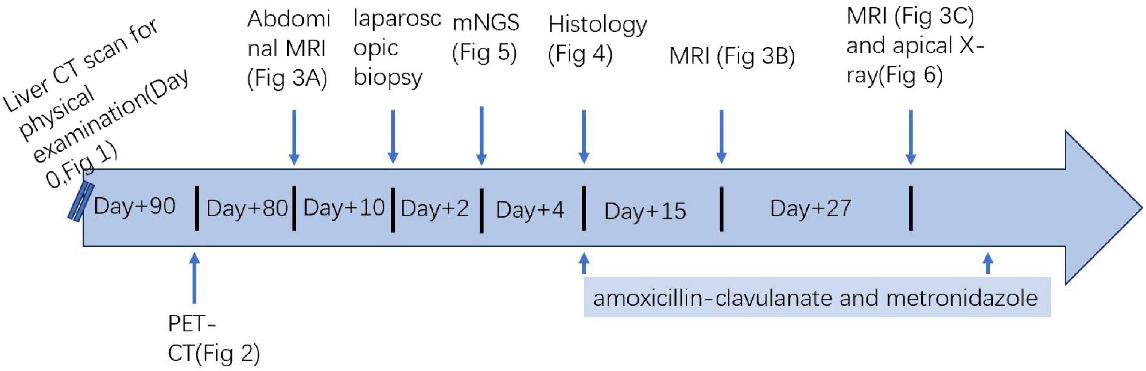 Timeline diagram showing a sequence of medical exams and treatments. Starting at Day 0 with a liver CT scan for a physical examination. Subsequent events include abdominal MRI on Day 10, laparoscopic biopsy and mNGS on Day 2, histology on Day 4, MRI on Day 15, with an MRI and apical X-ray on Day 27. PET-CT is on Day 90, with amoxicillin-clavulanate and metronidazole administered between Day 4 and Day 27. Arrowheads indicate direction and sequence.