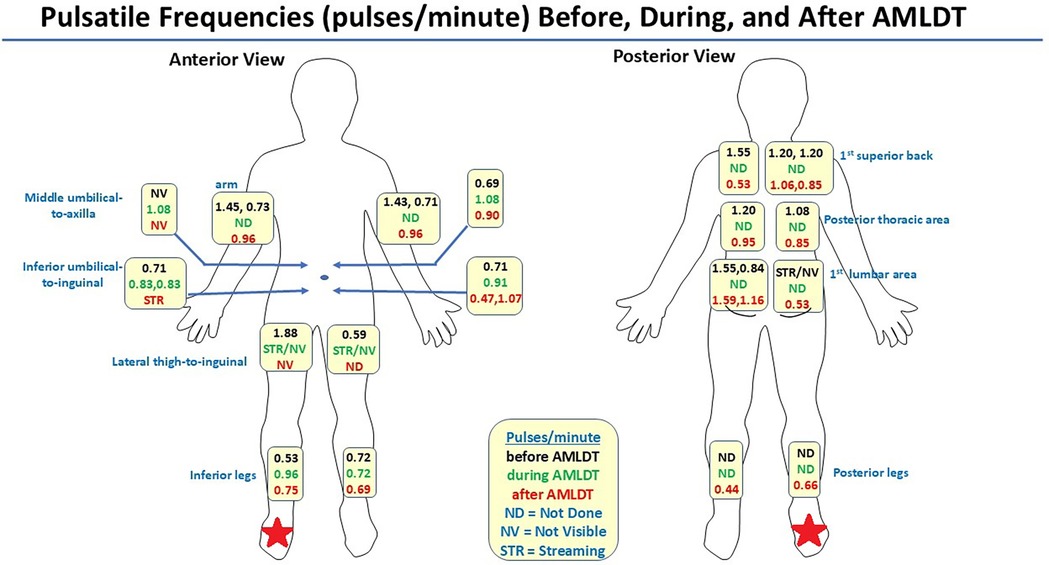 Anterior and posterior views of a human avatar showing pulsatile frequencies at various body locations before, during, and after AMLDT. Detailed areas include arm, abdomen, thigh, back, and lower legs. A legend explains abbreviations and color coding and the red stars indicate the affected limb.