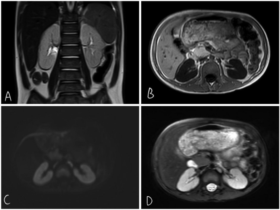 Four-panel MRI images of abdominal area showing different views and techniques: (A) Coronal view of kidneys and spine. (B) Axial view of abdomen. (C) Diffusion-weighted axial image highlighting kidneys. (D) Enhanced axial image with clear contrast of internal organs.