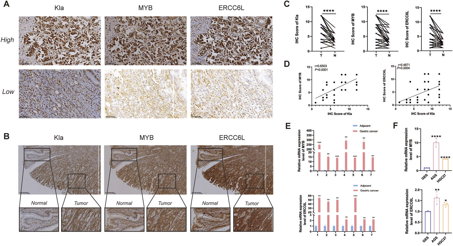 Panel A shows immunohistochemistry images of Kla, MYB, and ERCC6L expression, with high and low intensity. Panel B displays normal and tumor tissue staining for each protein. Panel C presents line graphs comparing immunohistochemistry scores of Kla, MYB, and ERCC6L between tumor (T) and normal (N) tissues, showing significant differences. Panel D includes scatter plots correlating Kla with MYB and ERCC6L scores, indicating positive correlations. Panel E shows bar graphs of relative mRNA expression levels of MYB and ERCC6L in adjacent vs. gastric cancer tissues. Panel F presents bar graphs of mRNA expression in different samples, highlighting significant expression changes.