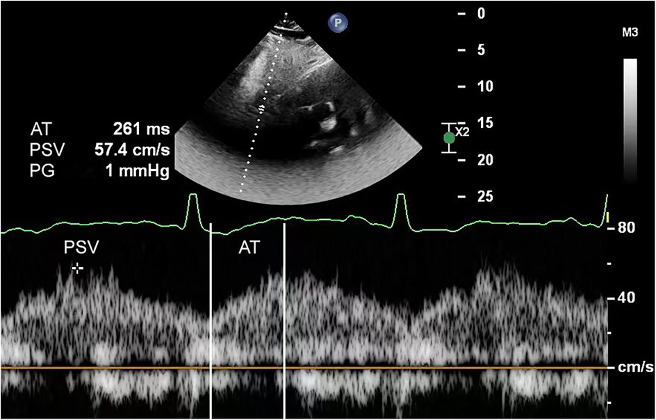 Ultrasound image displaying a Doppler waveform analysis with measurements. The PSV is 57.4 cm/s and PG is 1 mmHg. The graph shows velocity in relation to time, with a highlighted section marked AT at 261 milliseconds. The top half shows a standard ultrasound image.