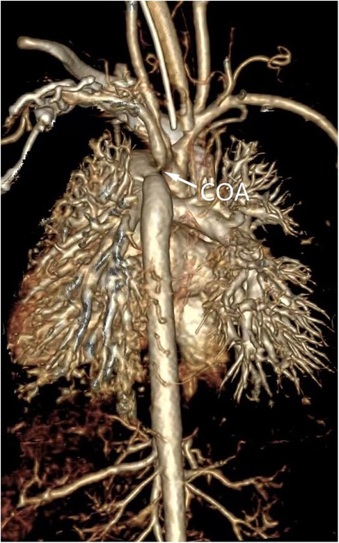 Three-dimensional CT angiography showing the vascular structure and anatomy of the heart. The image highlights a section labeled \