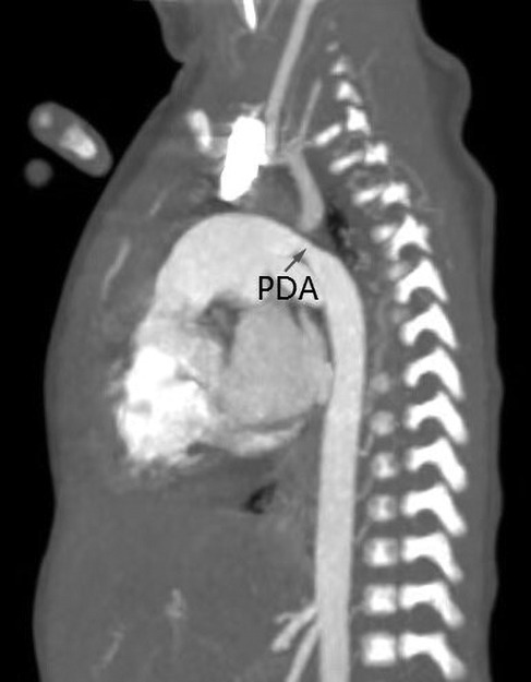 CT scan image of the thorax showing the heart and spine. An arrow points to an area labeled \