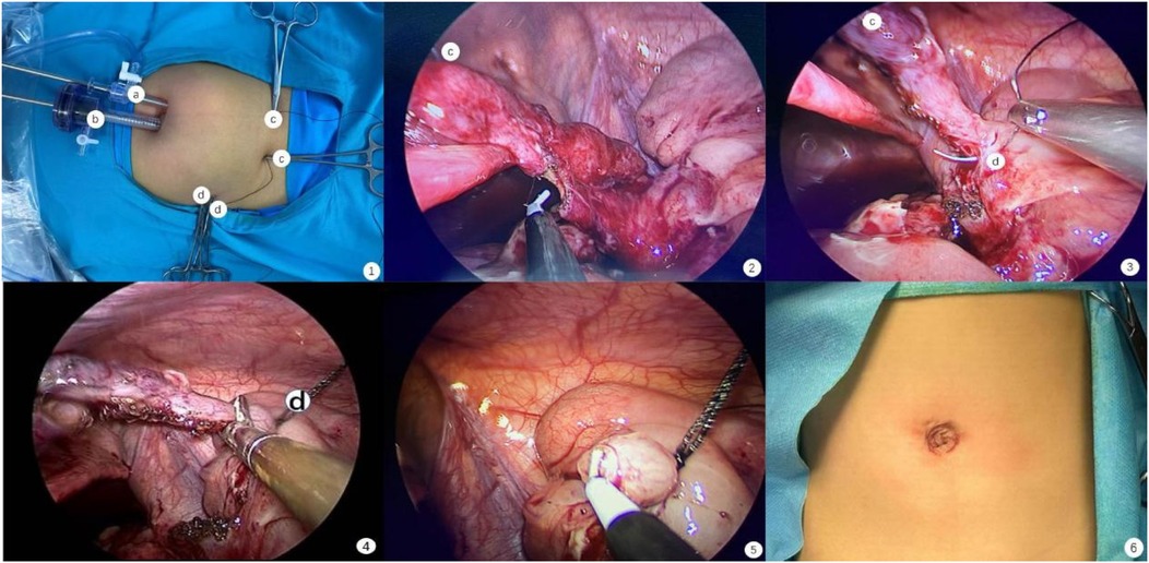 Composite image showing six stages of a laparoscopic surgical procedure. Panel 1 displays port placement on the abdomen with labeled instruments. Panels 2 through 5 depict various intraoperative laparoscopic views, including tissue dissection, suturing, and manipulation of organs using labeled tools. Panel 6 shows the postoperative umbilical incision site with minimal scarring.