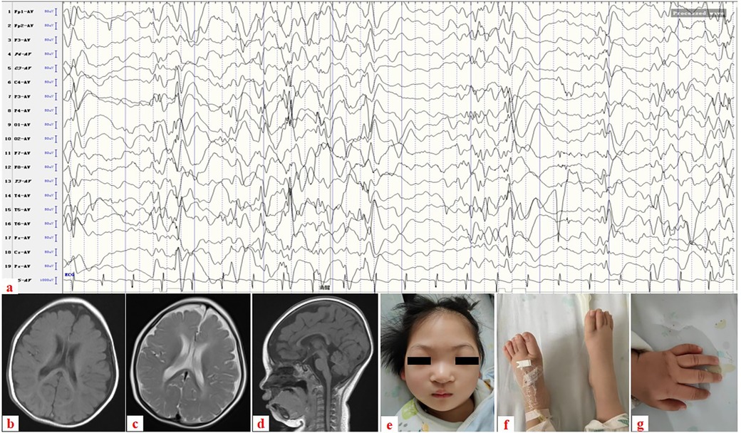 An EEG chart showing brain wave patterns is at the top, labeled a. Below are three MRI scans of the brain in different views, labeled b, c, and d. A photo of a child with eyes covered, labeled e, follows. Next, a close-up of a child's legs with one wrapped in bandages, labeled f. Lastly, a close-up of a child's hand with a bandaged finger, labeled g.