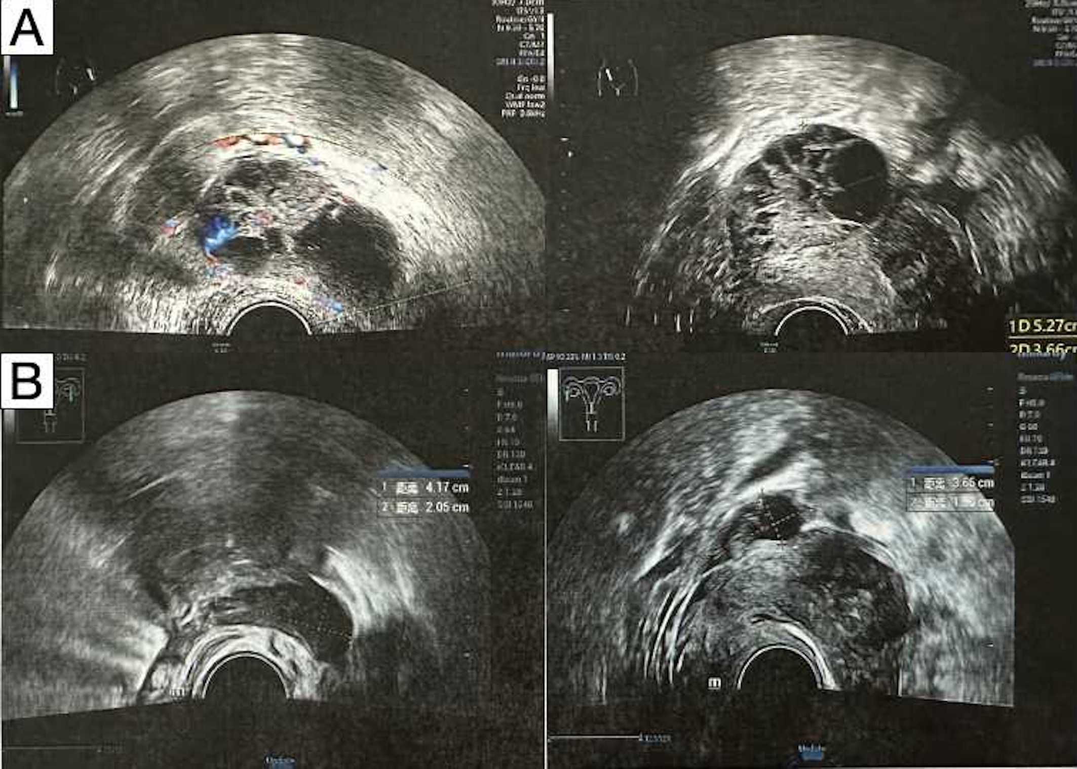 Ultrasound images labeled A and B, featuring four panels in total. Each image shows different sections of a pelvic ultrasound, highlighting measurements of specific areas with numerical data, possibly indicating tumors. Various anatomical structures are visible, with color Doppler details in some images.
